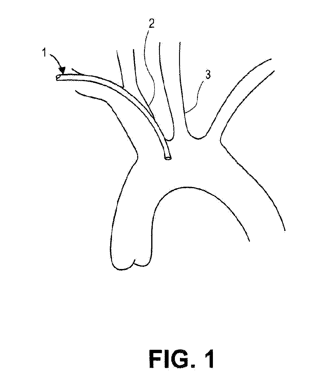 Steerable Dual Filter Cerebral Protection System