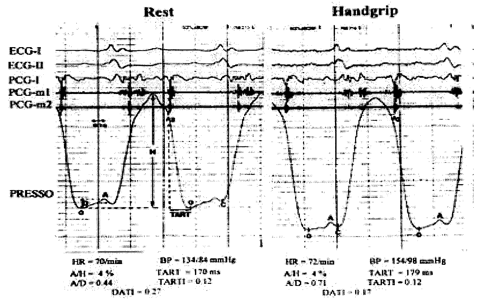 Device for and method of rapid noninvasive measurement of parameters of diastolic function of left ventricle and automated evaluation of the measured profile of left ventricular function at rest and with exercise