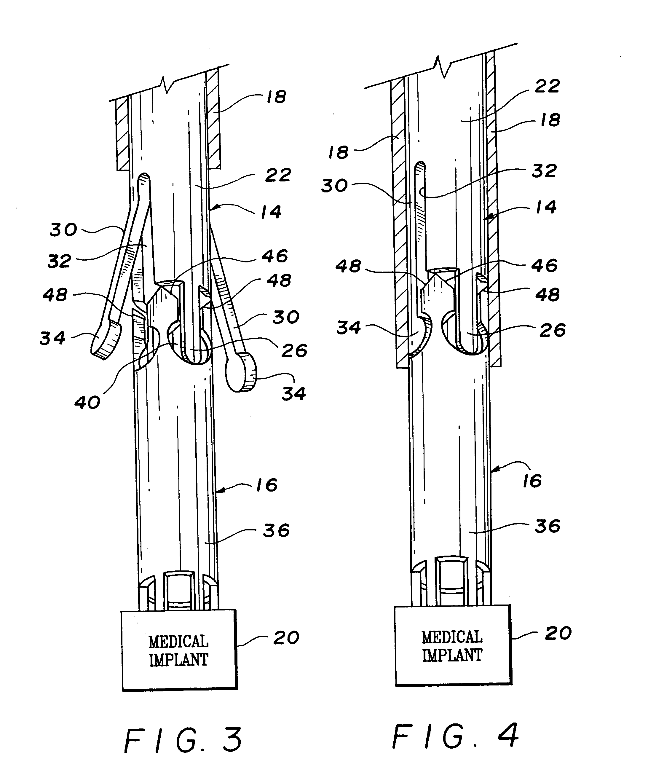 Over-the-wire interlock attachment/detachment mechanism