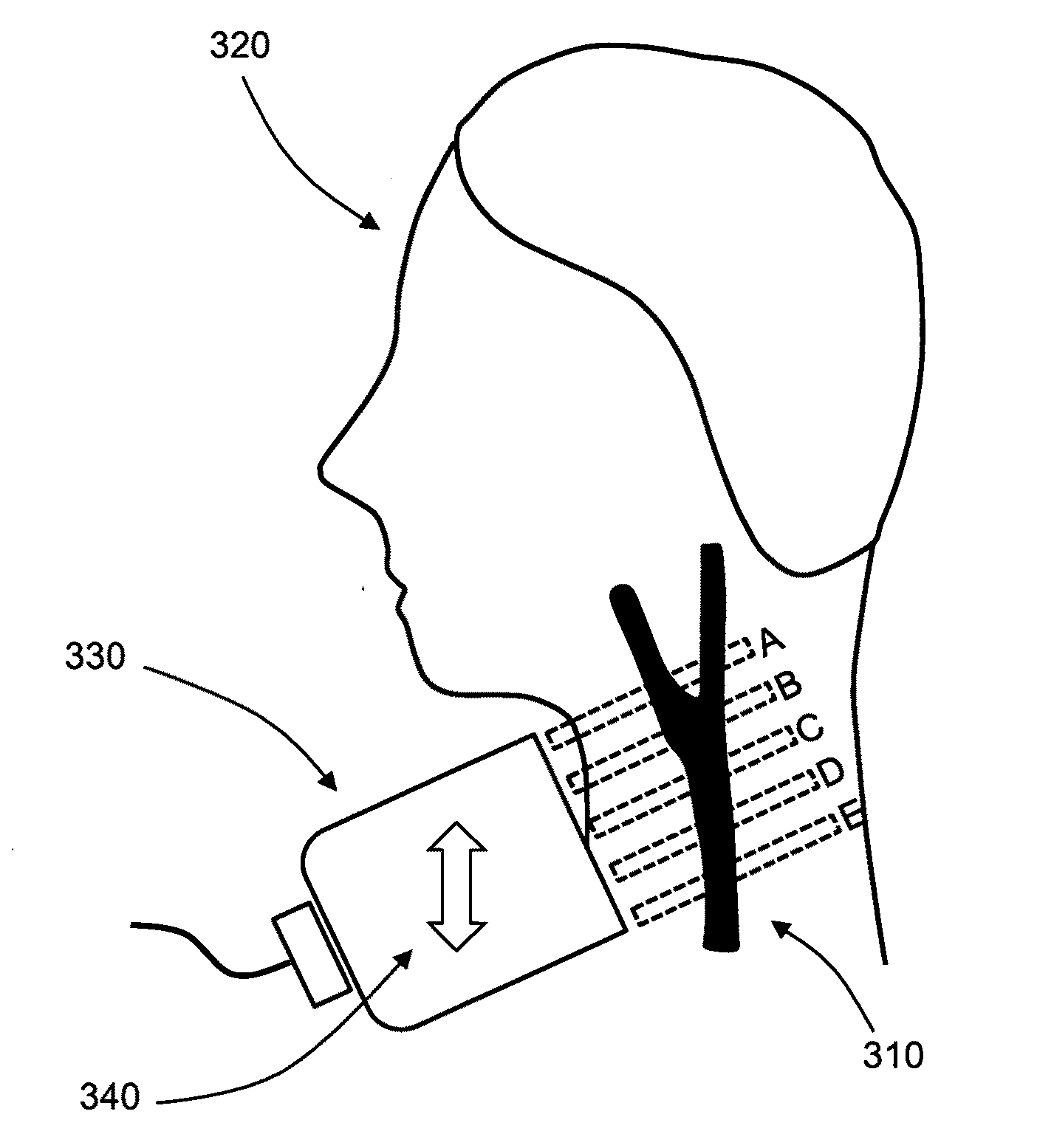 Automated detection of asymptomatic carotid stenosis