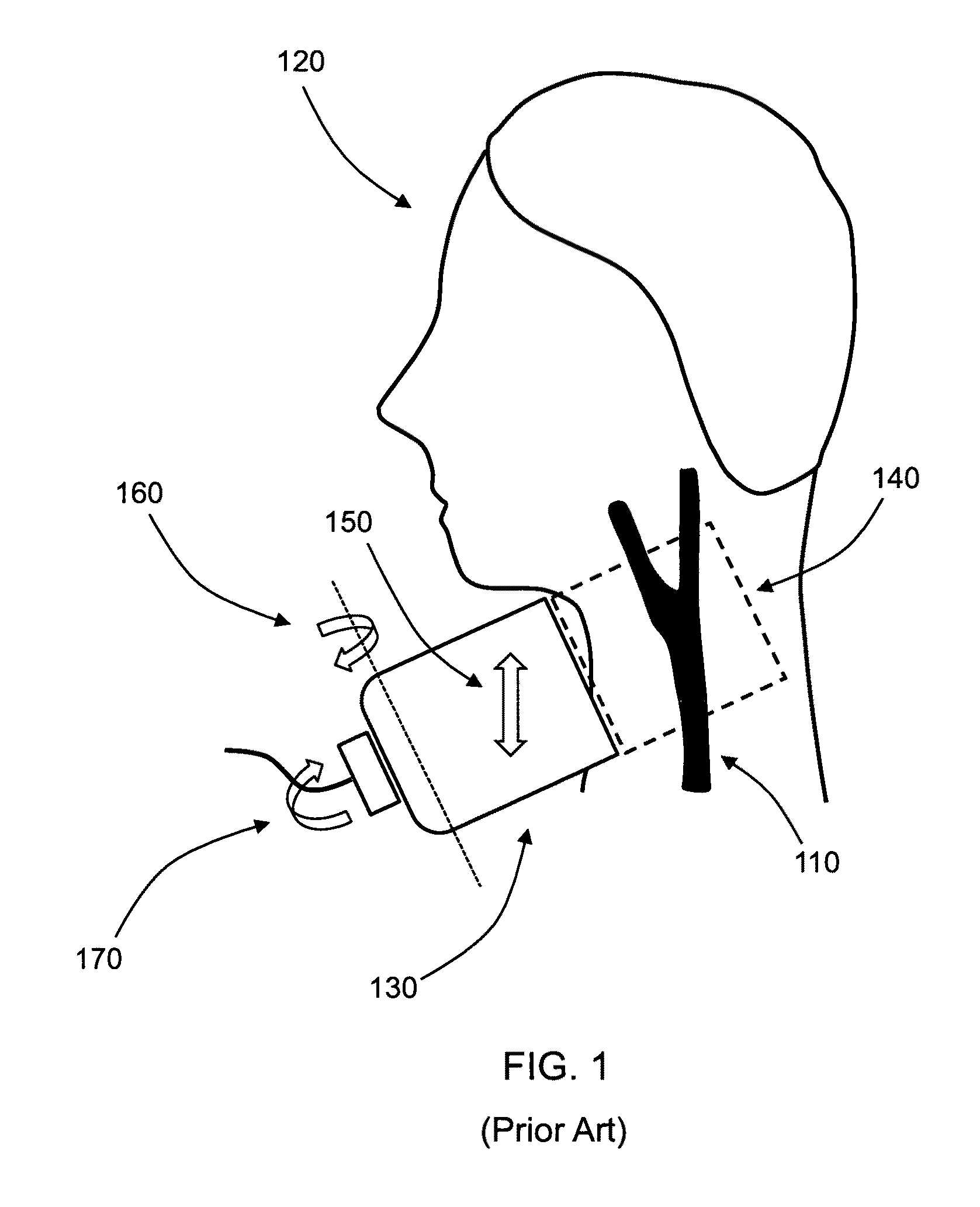 Automated detection of asymptomatic carotid stenosis