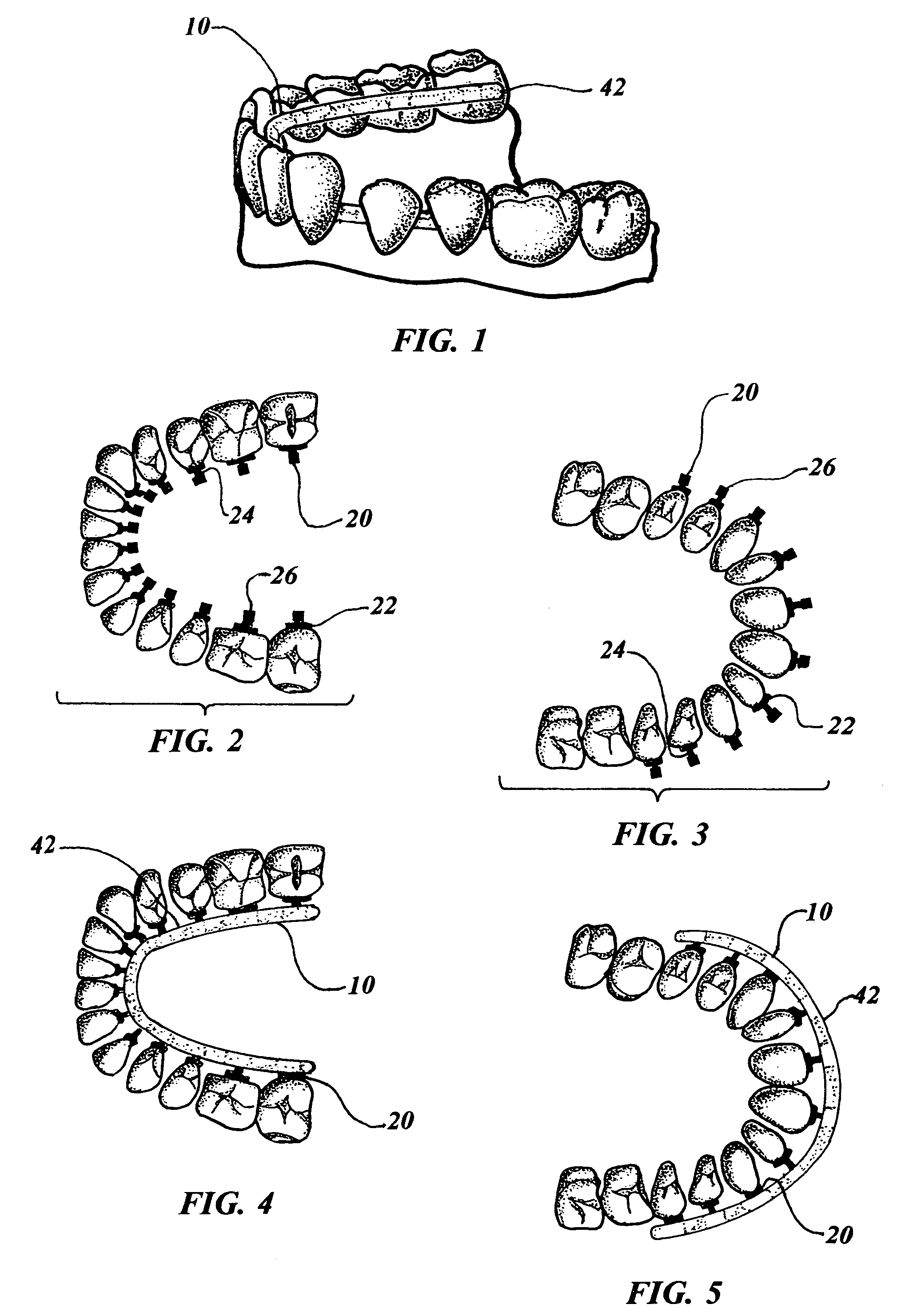 Computer configured appliance for orthodontic correction of malocclusions