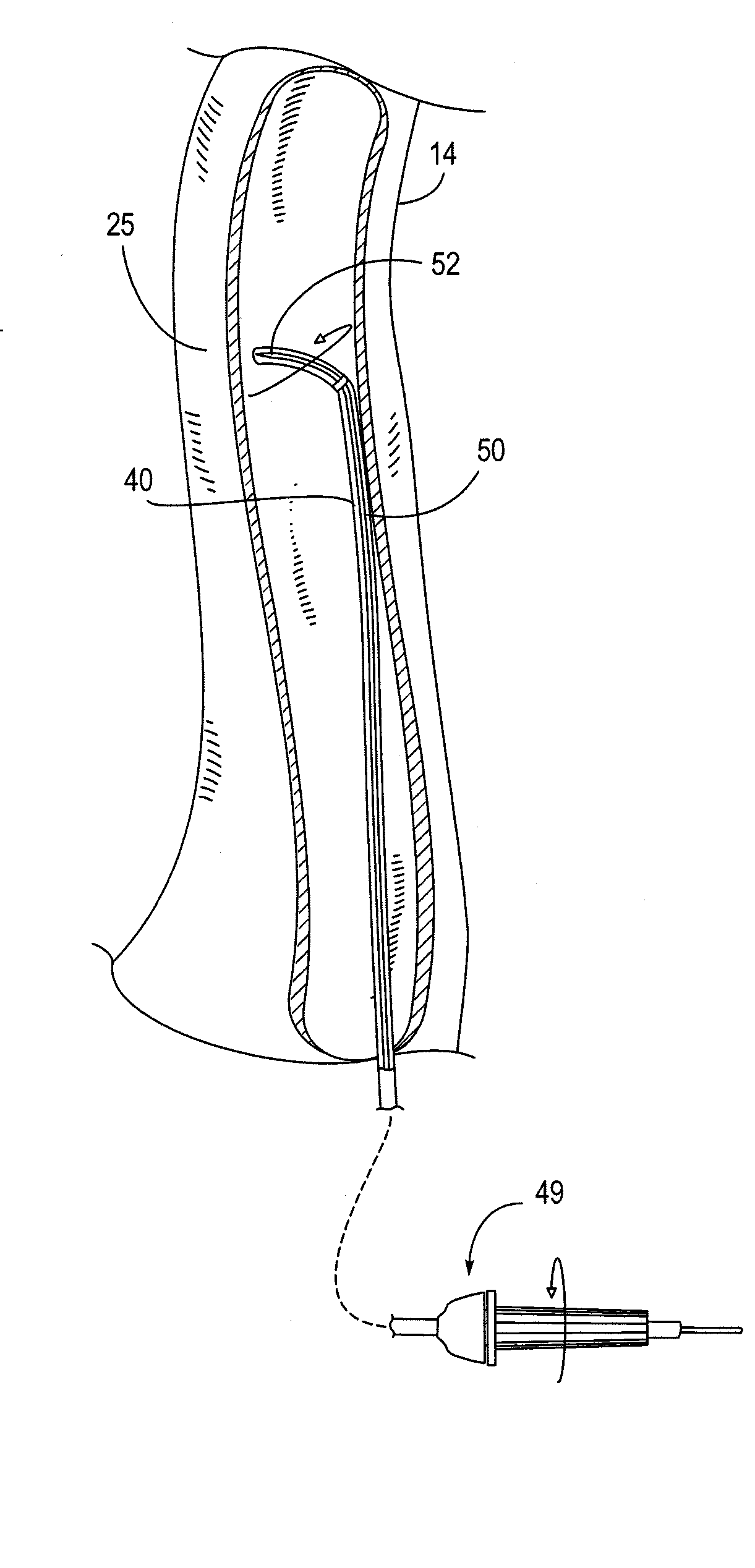 Methods of Transvascular Retrograde Access Placement and Devices for Facilitating the Placement