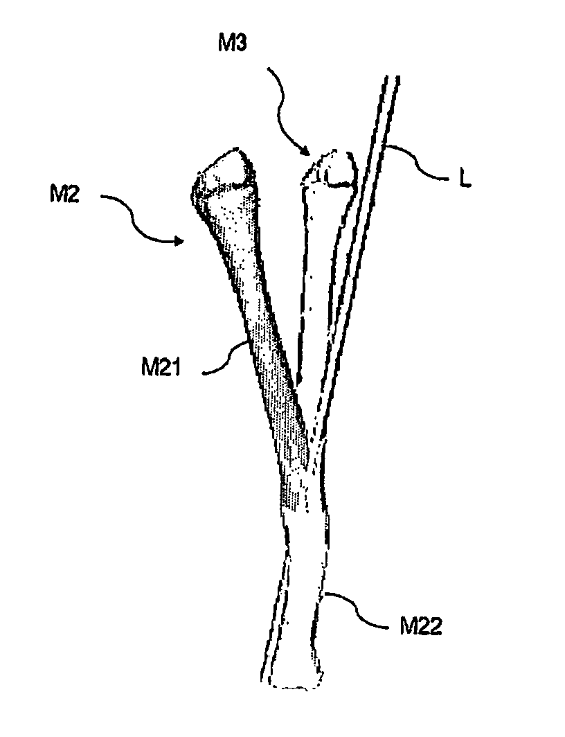 Method, members, system and program for bone correction