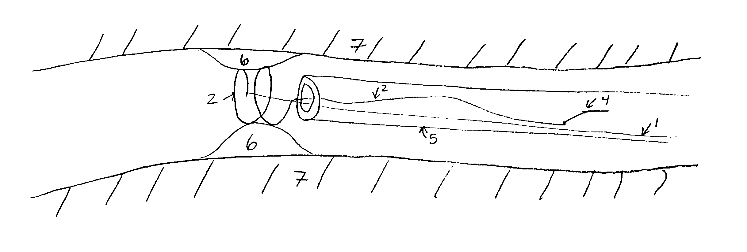 Stent devices with detachable distal or proximal wires