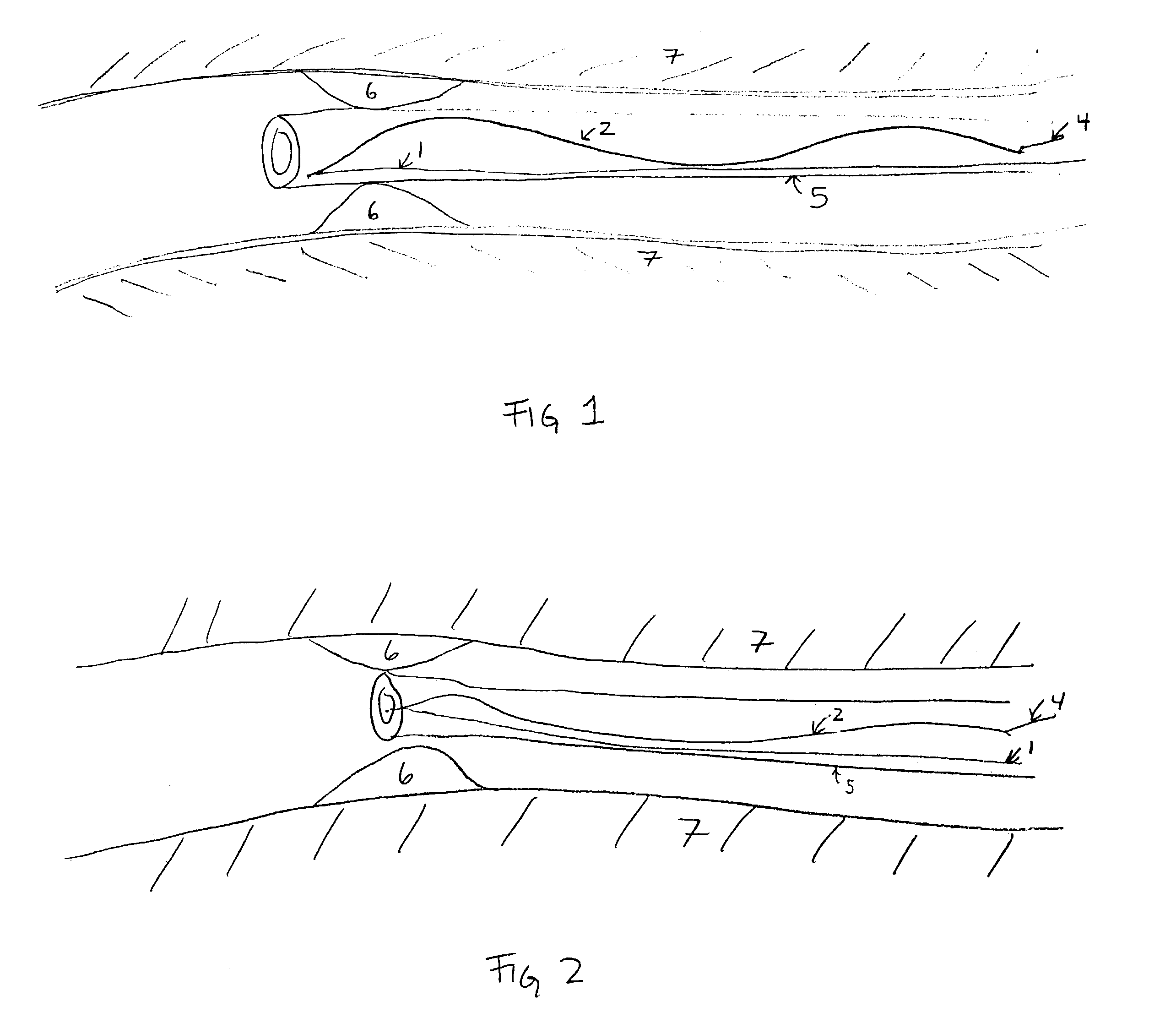 Stent devices with detachable distal or proximal wires