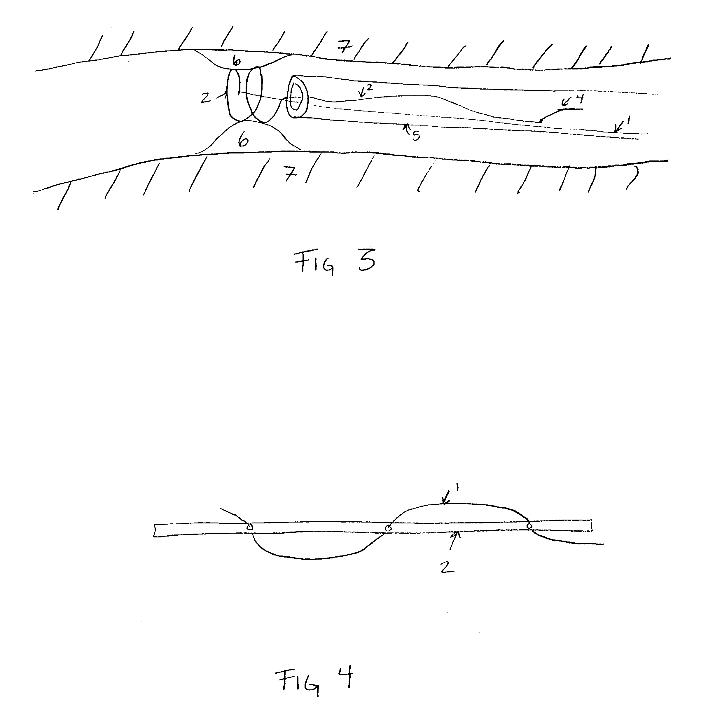 Stent devices with detachable distal or proximal wires