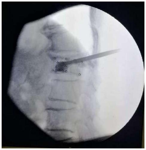 Vertebral plasty bone cement leakage detection method and system and storage medium