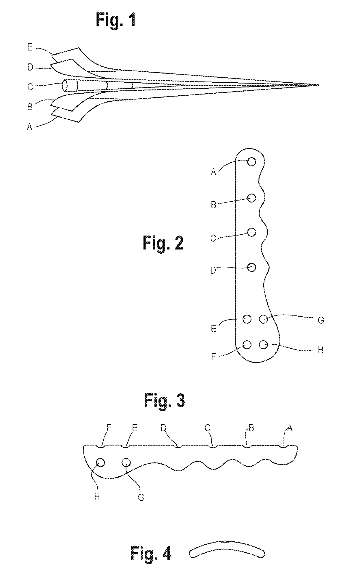 Metal alloy mono and poly-filament wire reinforced carbon fiber plating system with electromagnetic bone stimulation