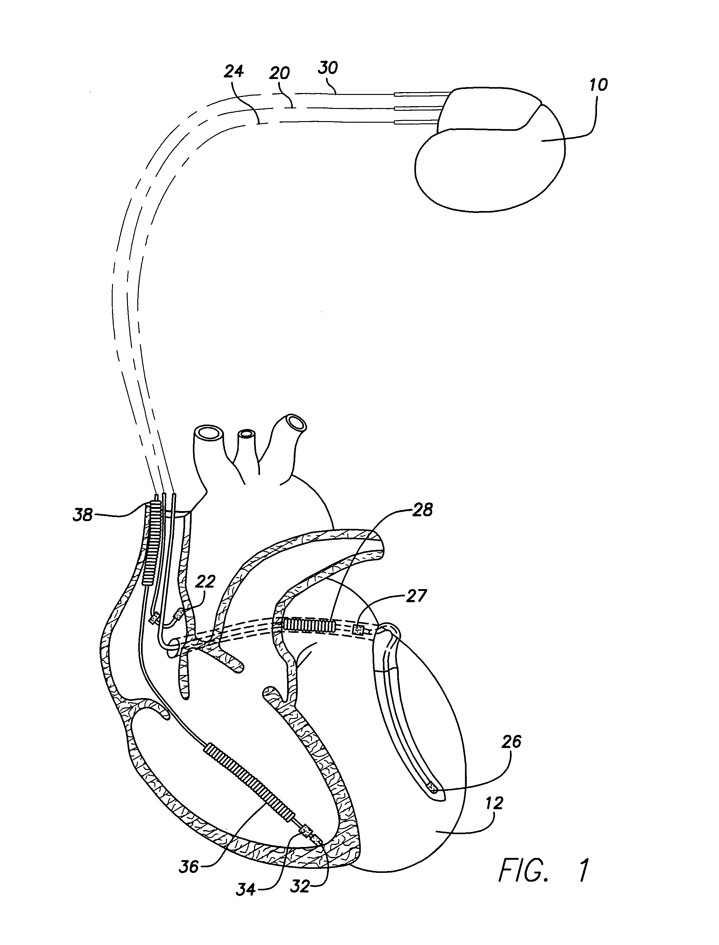 Implantable cardiac stimulation device and method for measuring intrinsic activity metrics in multi-site pacing