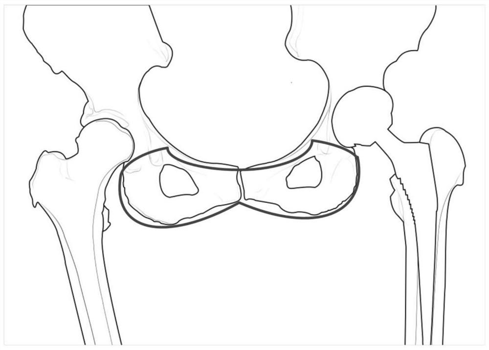 Hip replacement post-operation image evaluation method and system based on deep learning