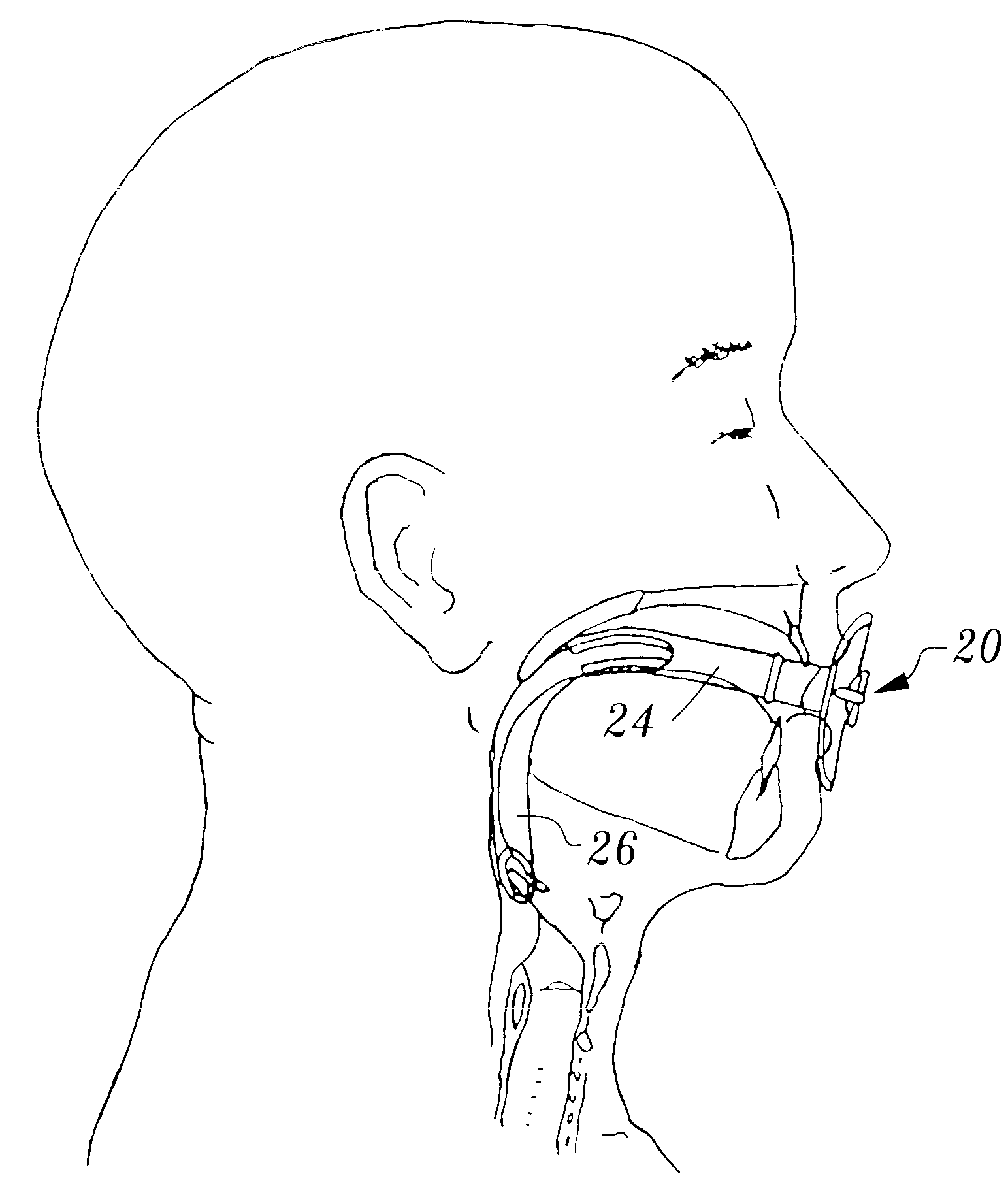 Adjustable oropharyngeal airway apparatus