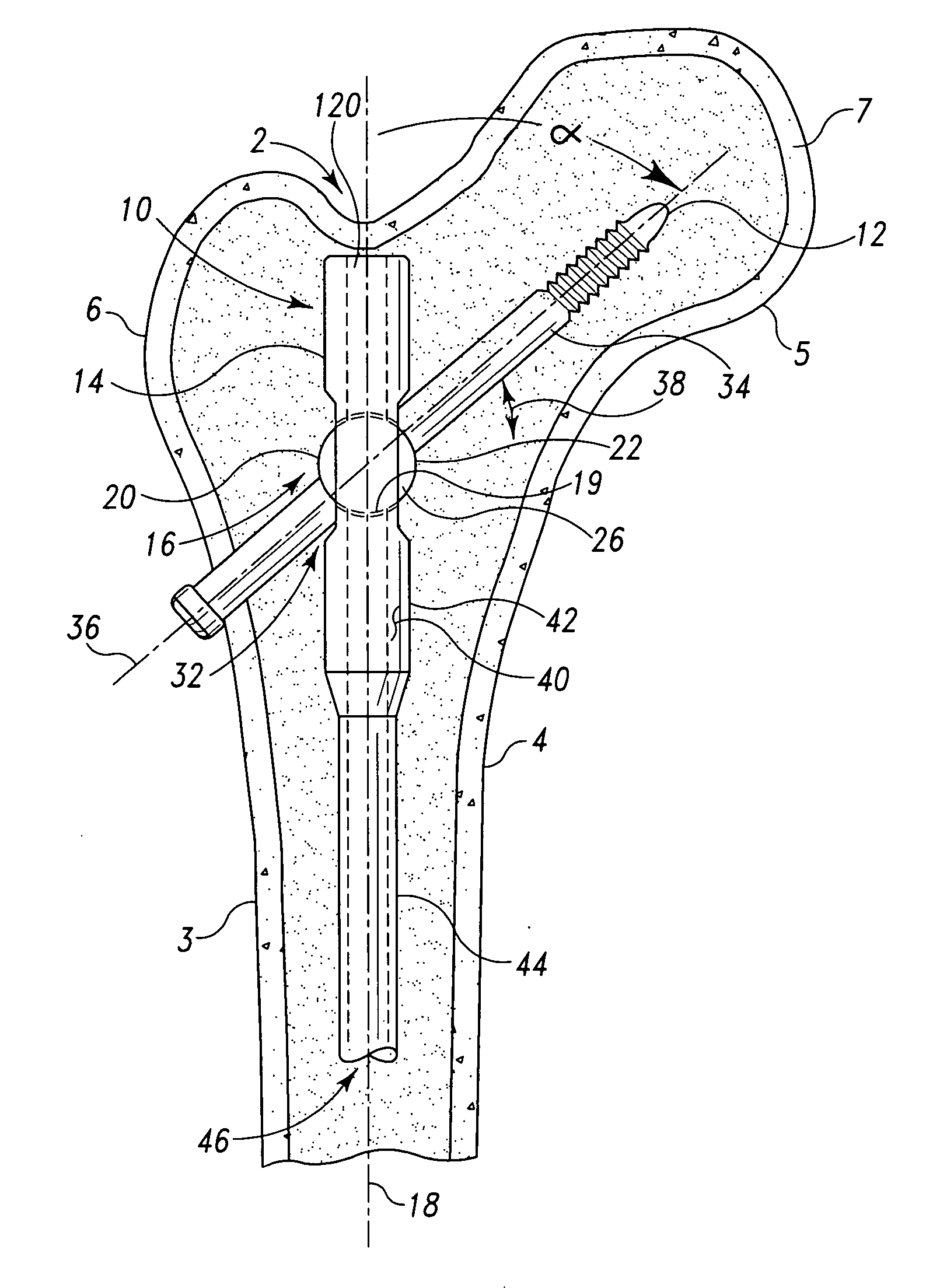 Variable angle intramedullary nail