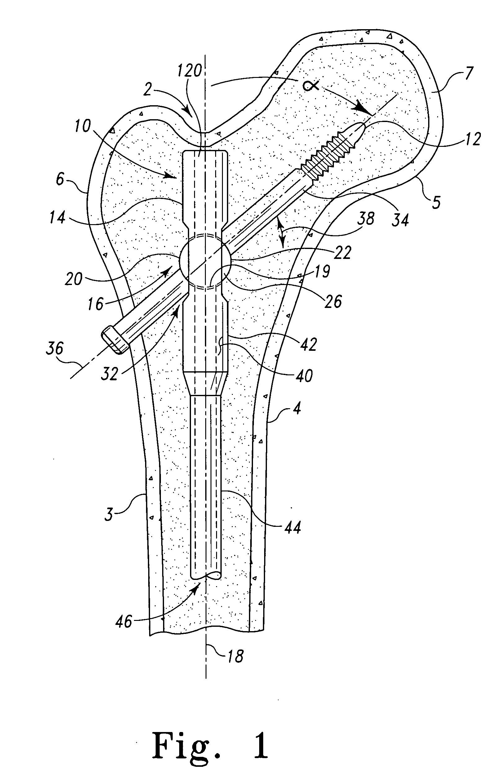 Variable angle intramedullary nail