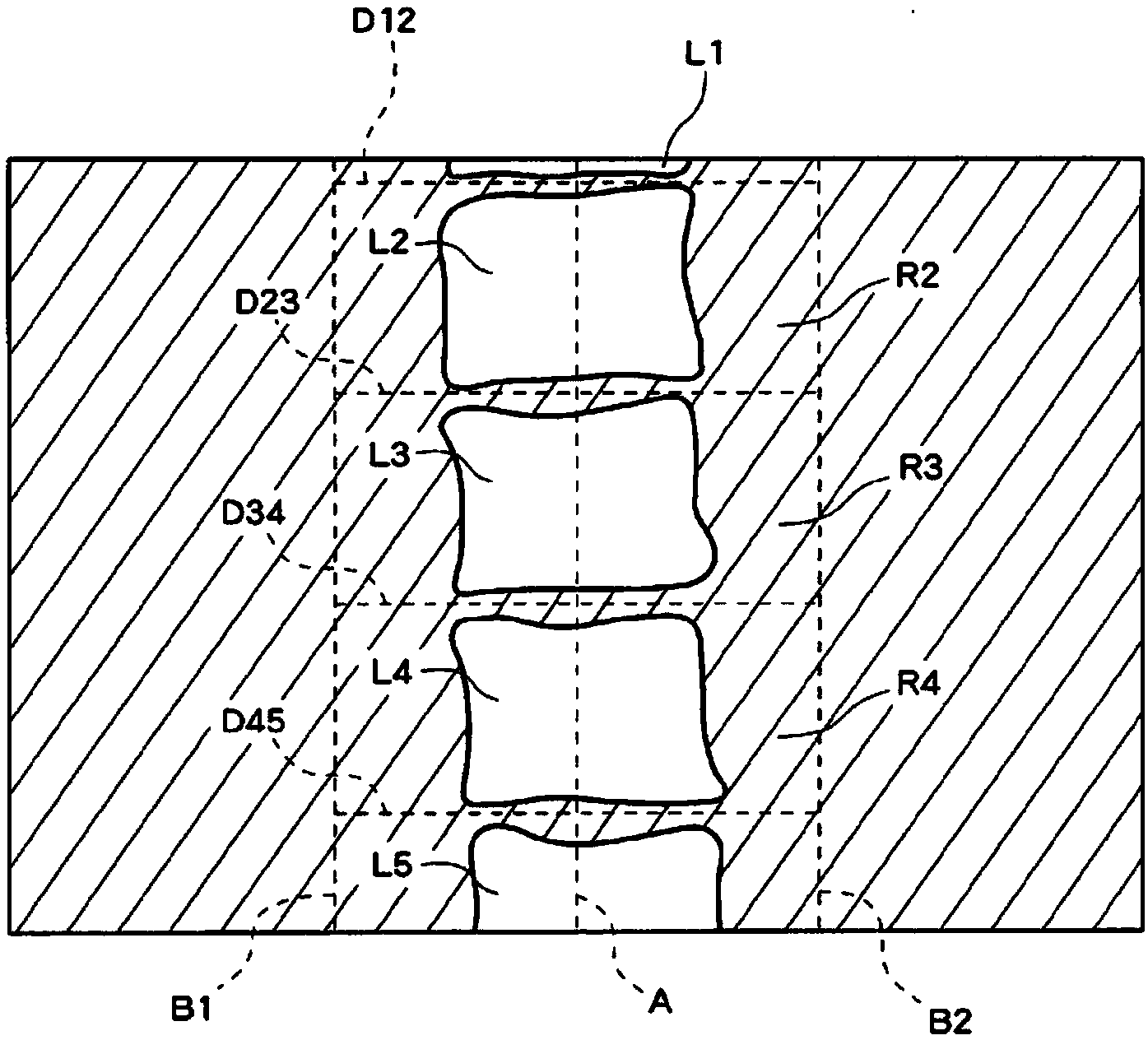 Bone mineral density-measuring device