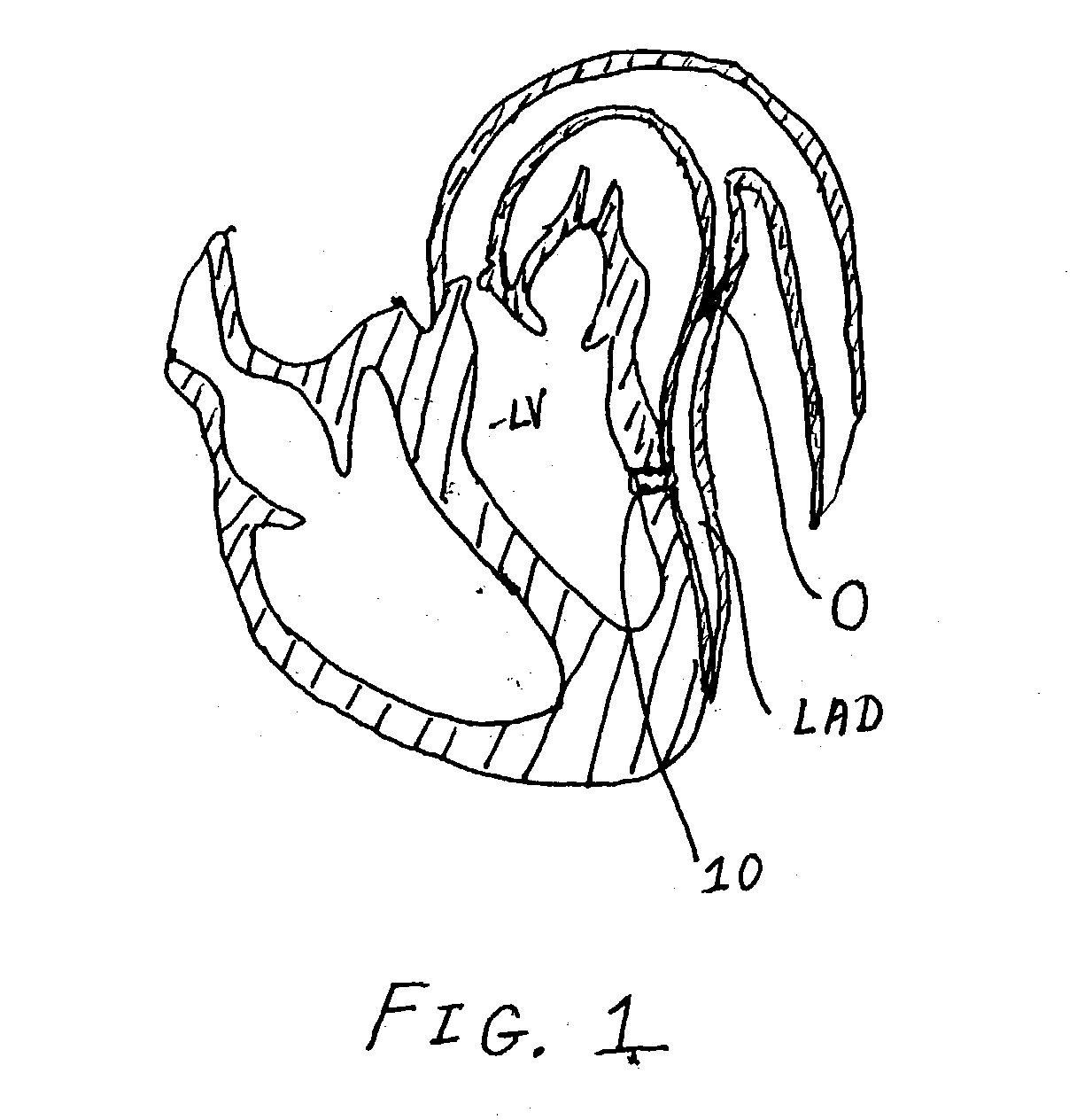 Methods for inducing vascular remodeling and related methods for treating diseased vascular structures