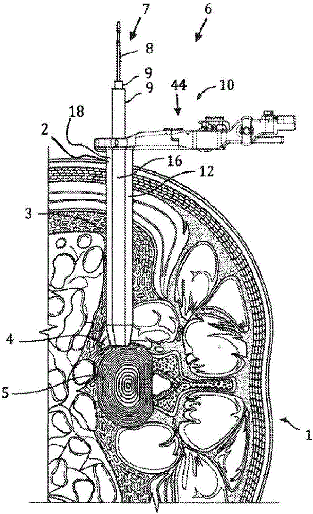 Retractor assembly