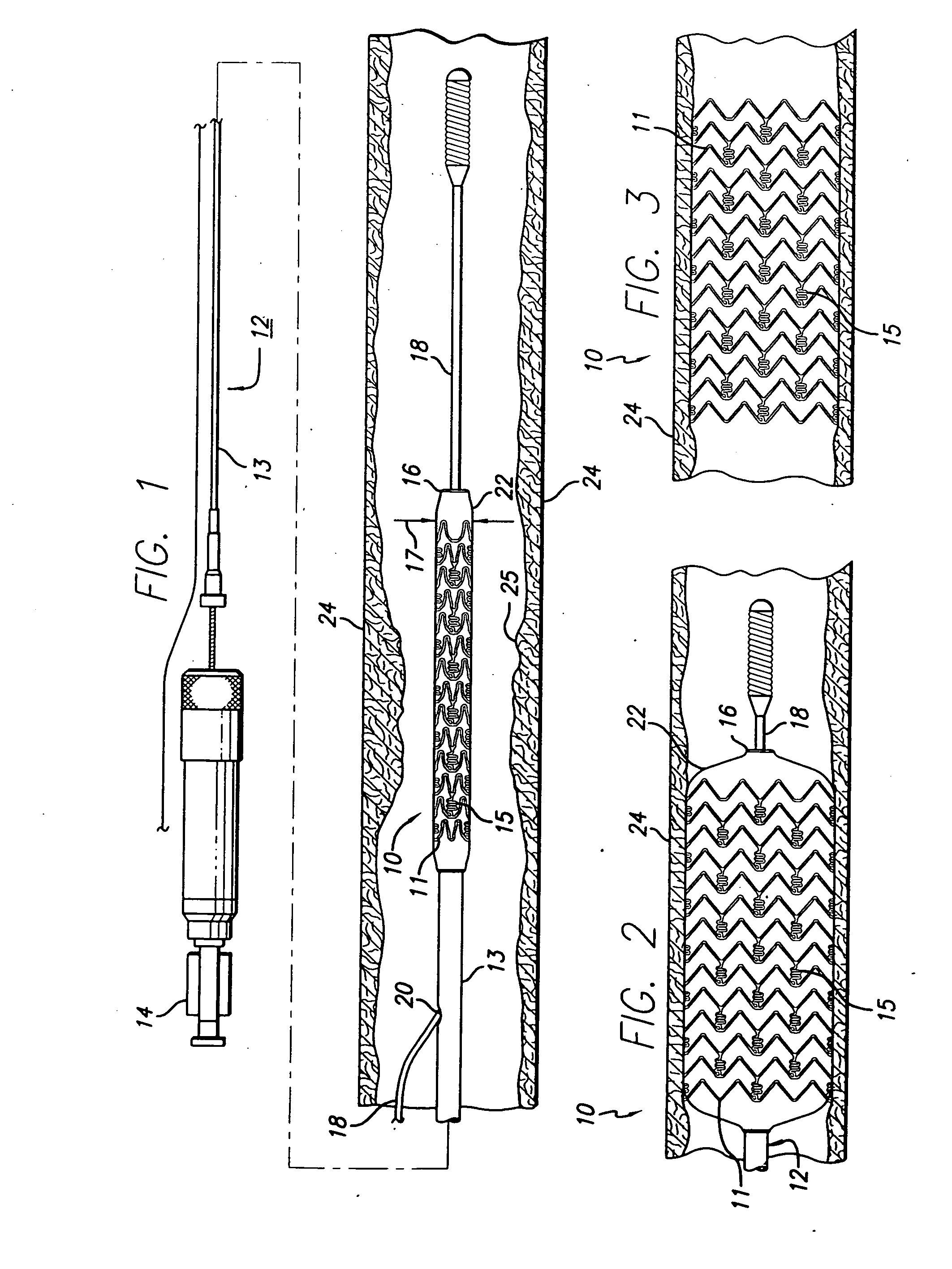 Drug-eluting stent and methods of making the same