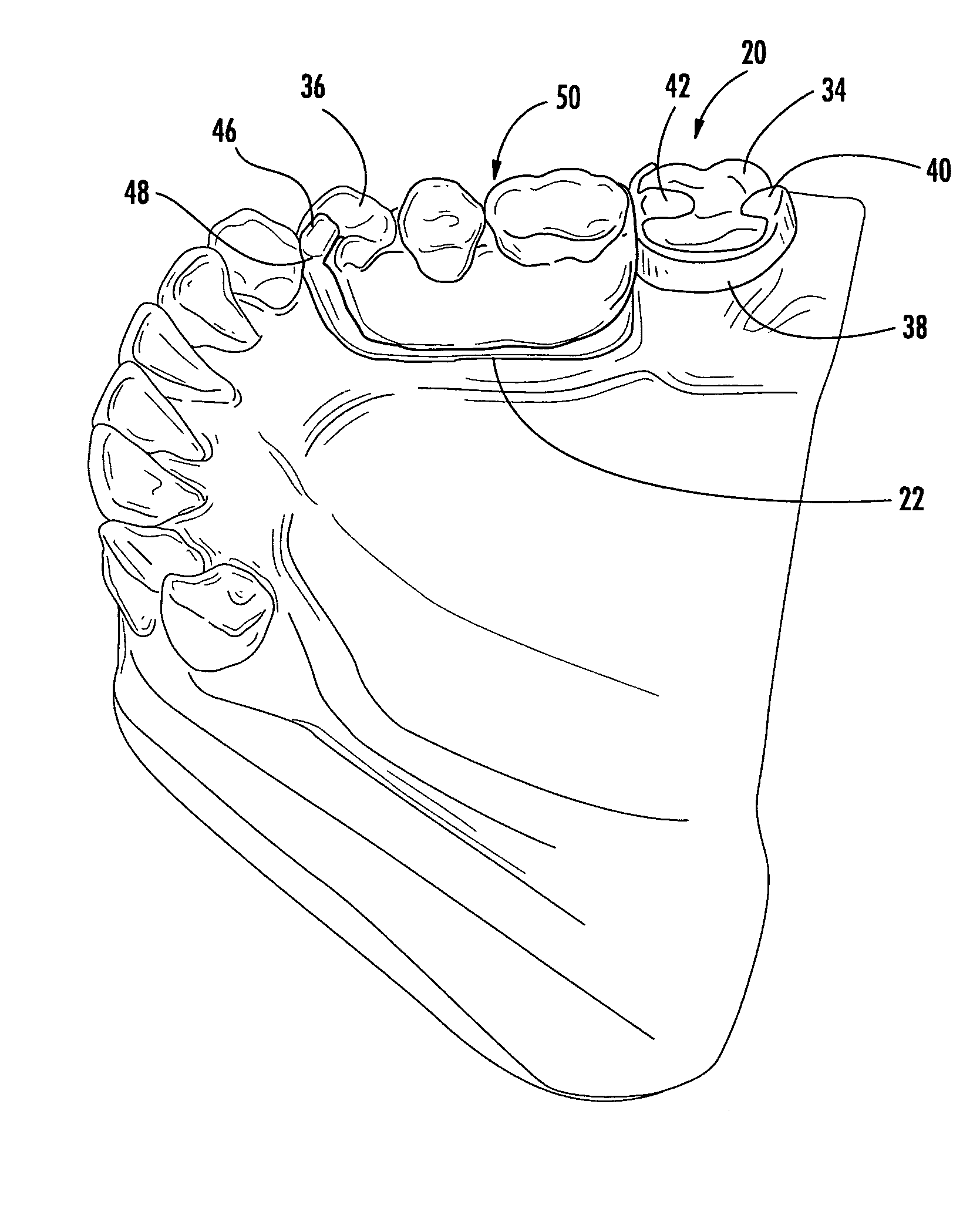 Denture device