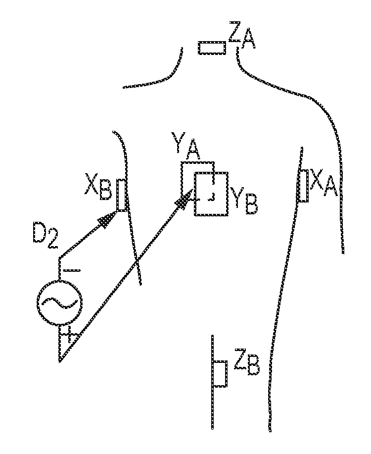 Dynamic adaptive respiration compensation with automatic gain control