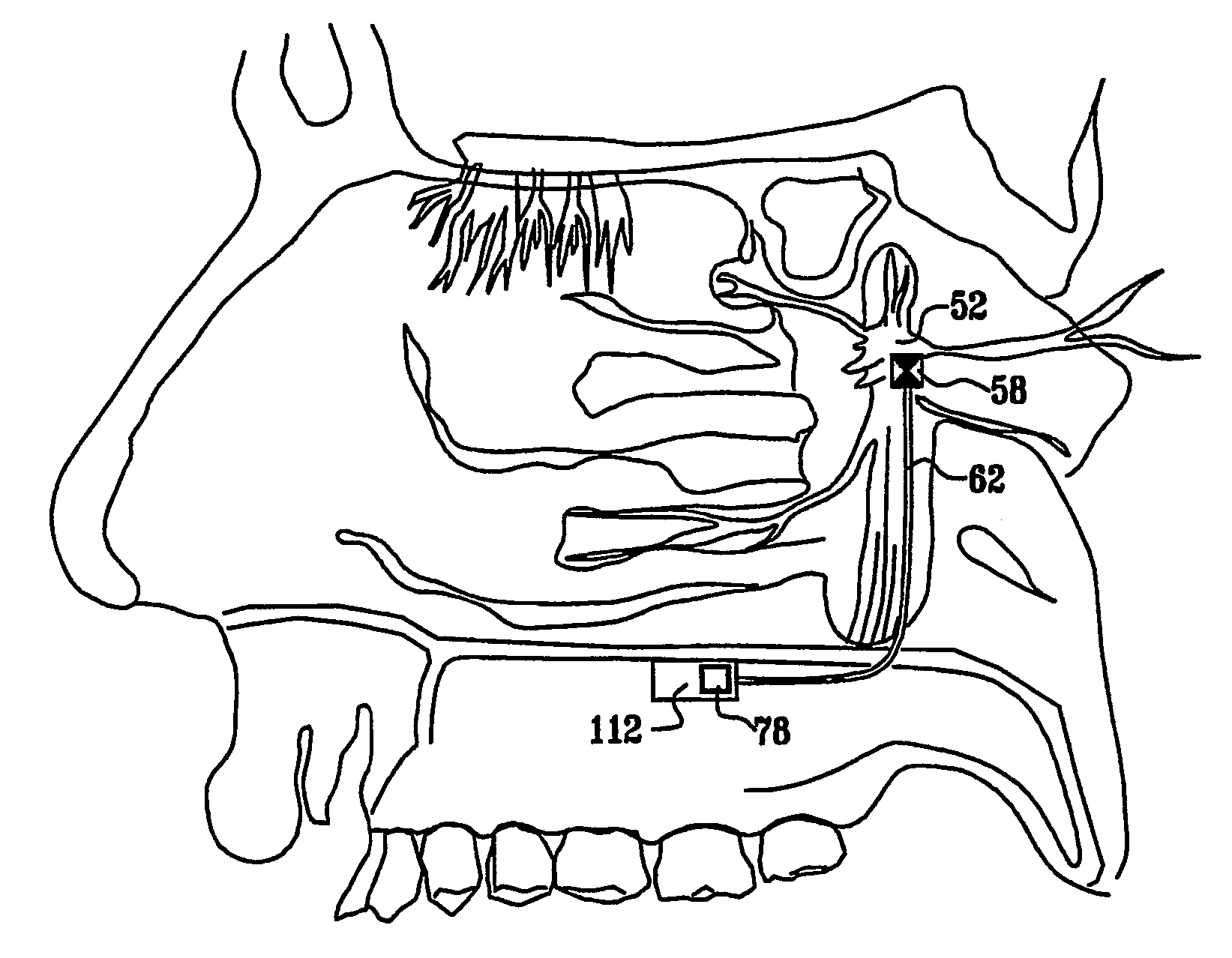 Surgical tools and techniques for stimulation