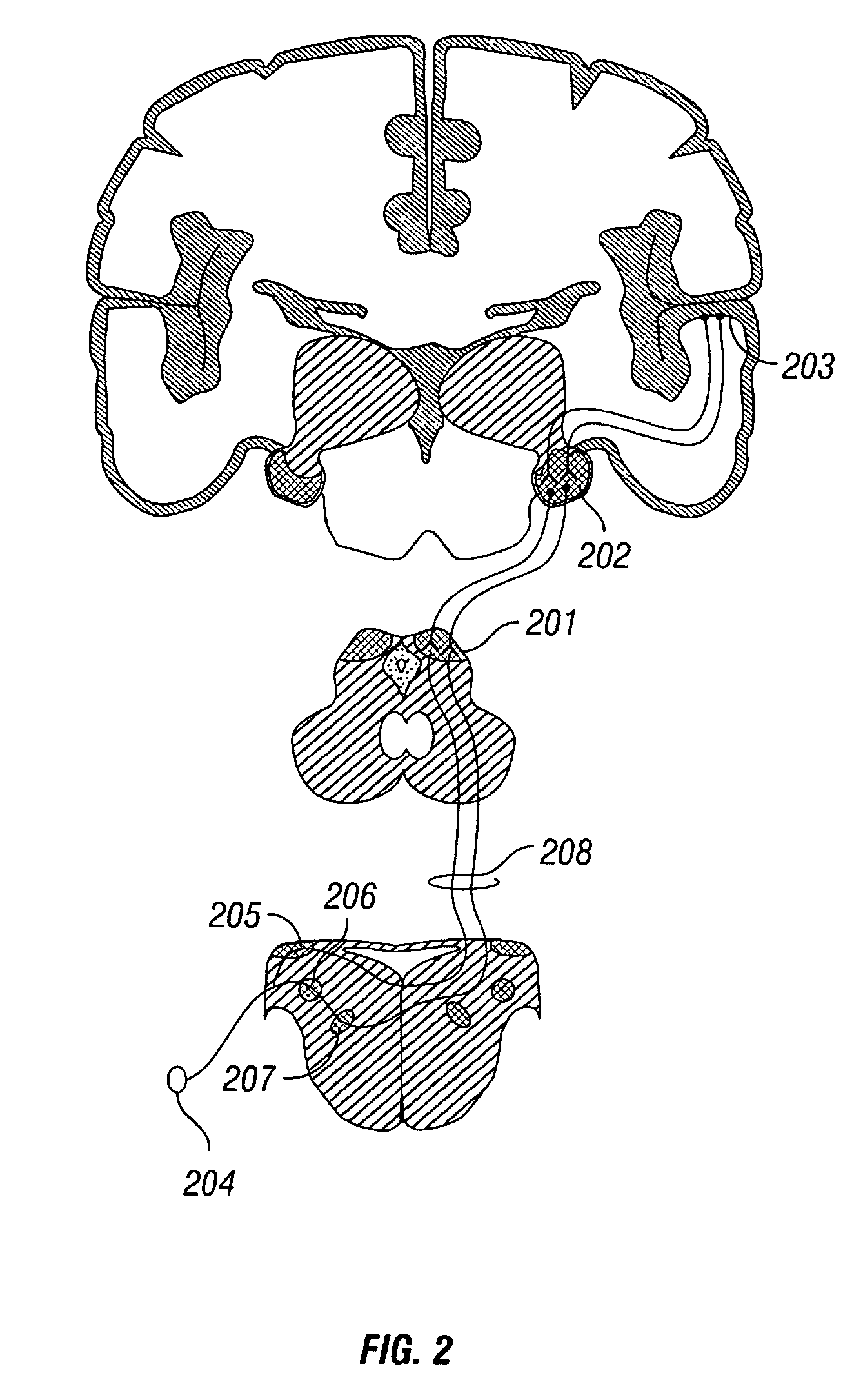 Peripheral nerve stimulation to treat auditory dysfunction