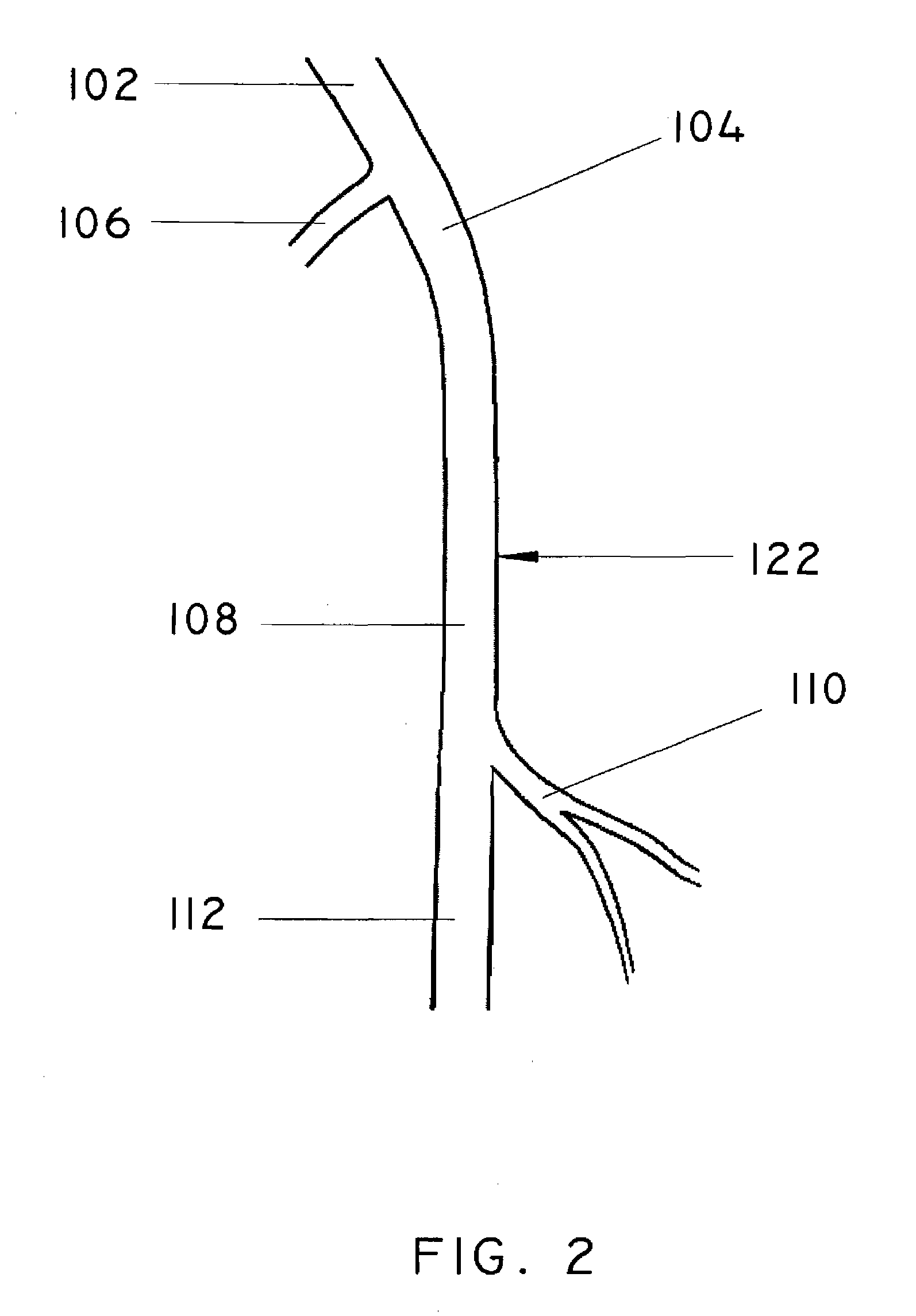 Methods and apparatus for extraluminal femoropopliteal bypass graft