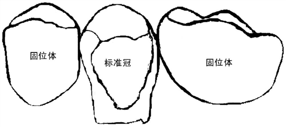 A digital generation method for a bridge body of a crown bridge