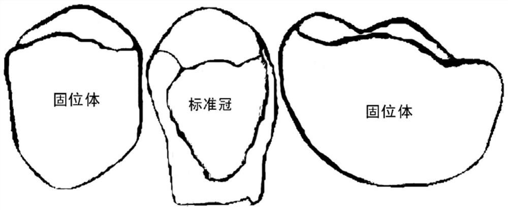 A digital generation method for a bridge body of a crown bridge