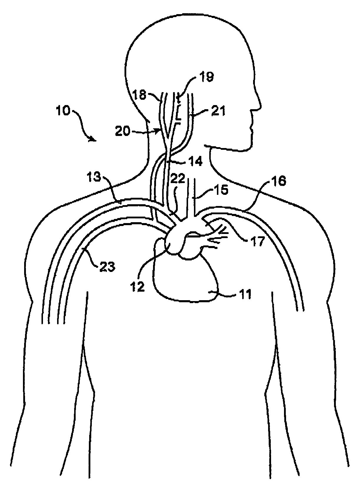 External baroreflex activation