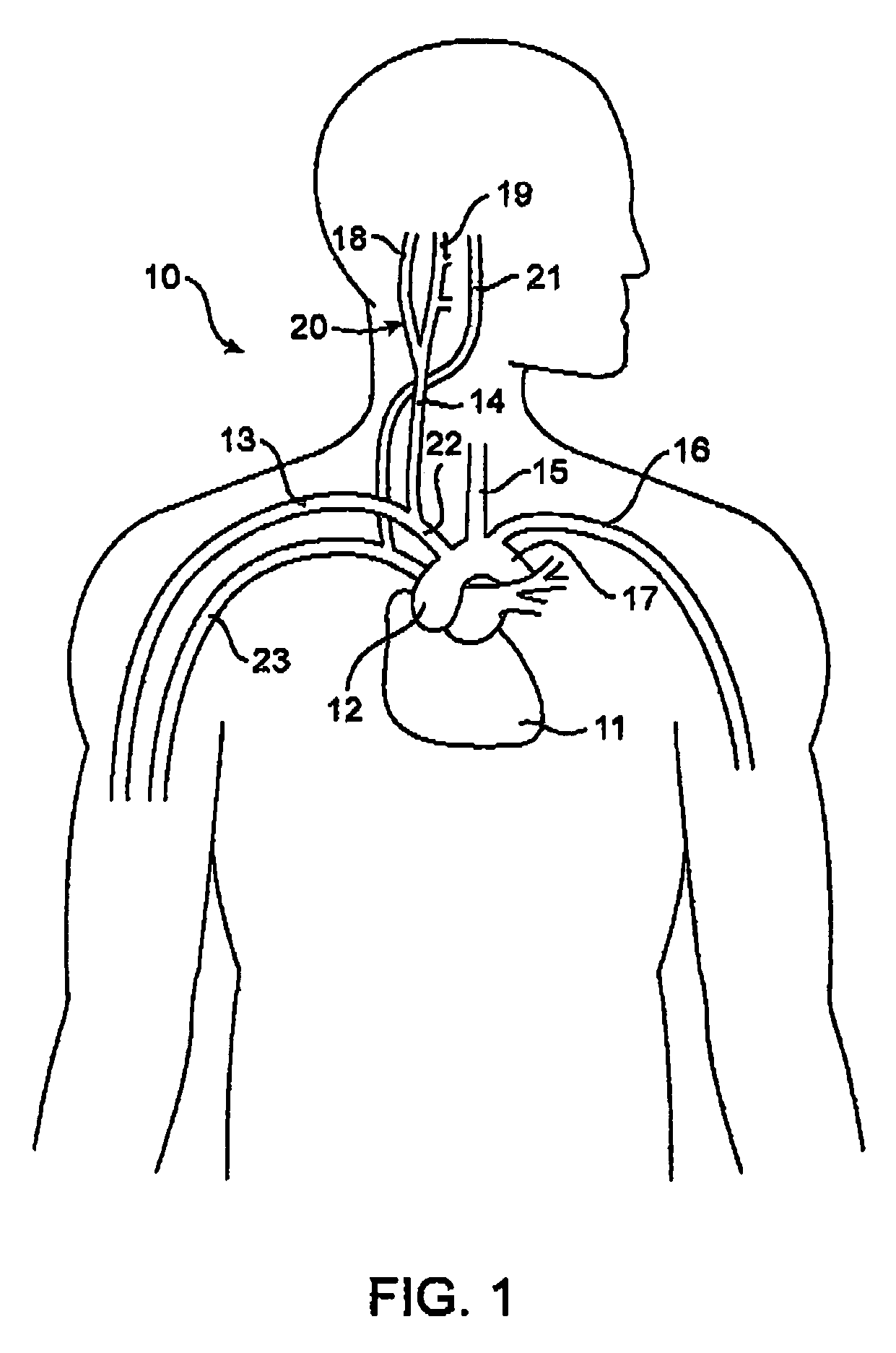 External baroreflex activation