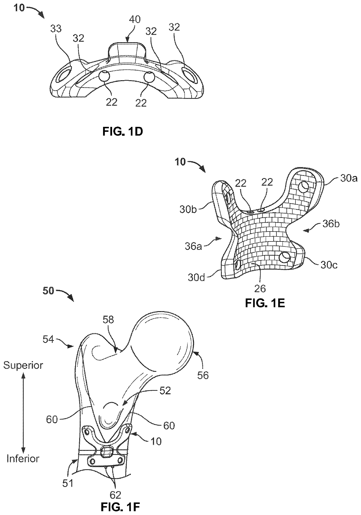 Medial Trochanteric Plate Fixation