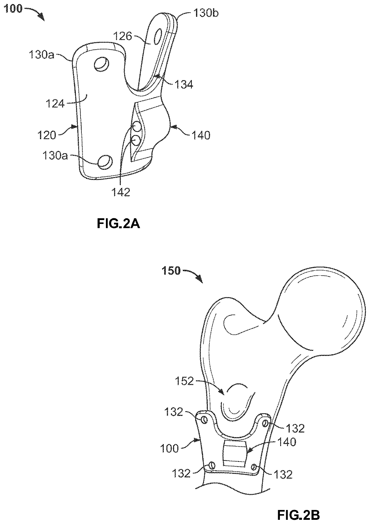 Medial Trochanteric Plate Fixation