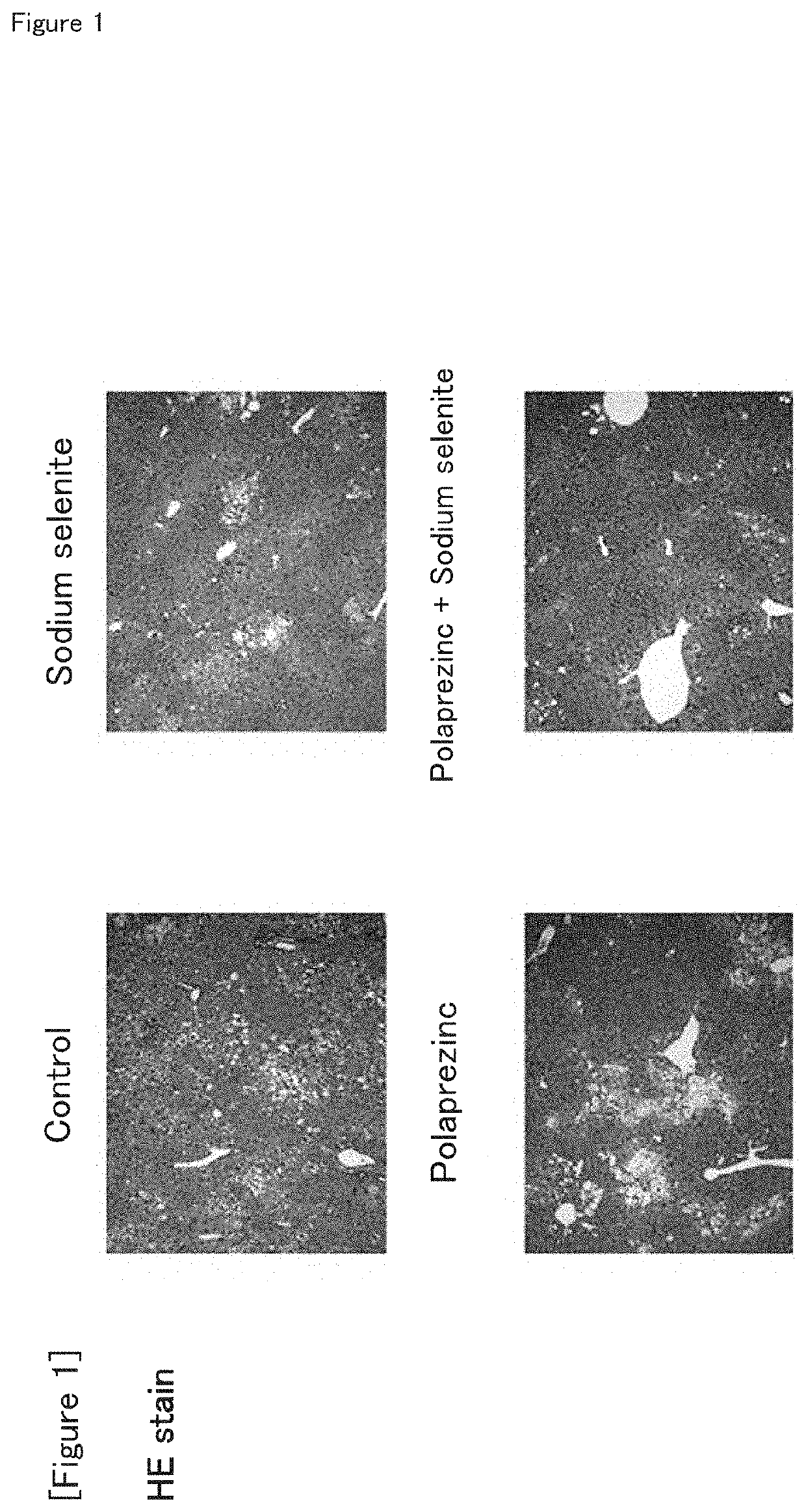 Combination drug suitable for treatment and prevention of non-alcoholic fatty liver disease (NAFLD) and/or non-alcoholic steatohepatitis (NASH), and/or hepatic fatty degeneration