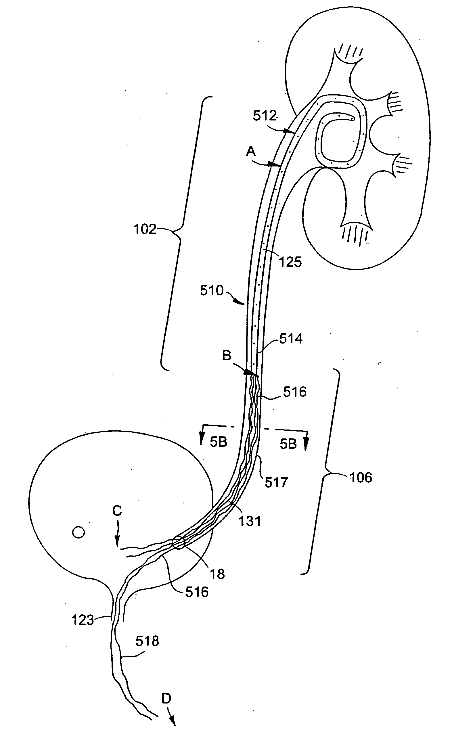 Ureteral stent for improved patient comfort