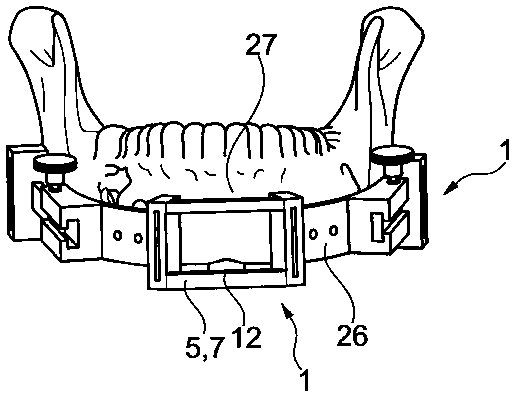 Fibula bone material removal and transfer template