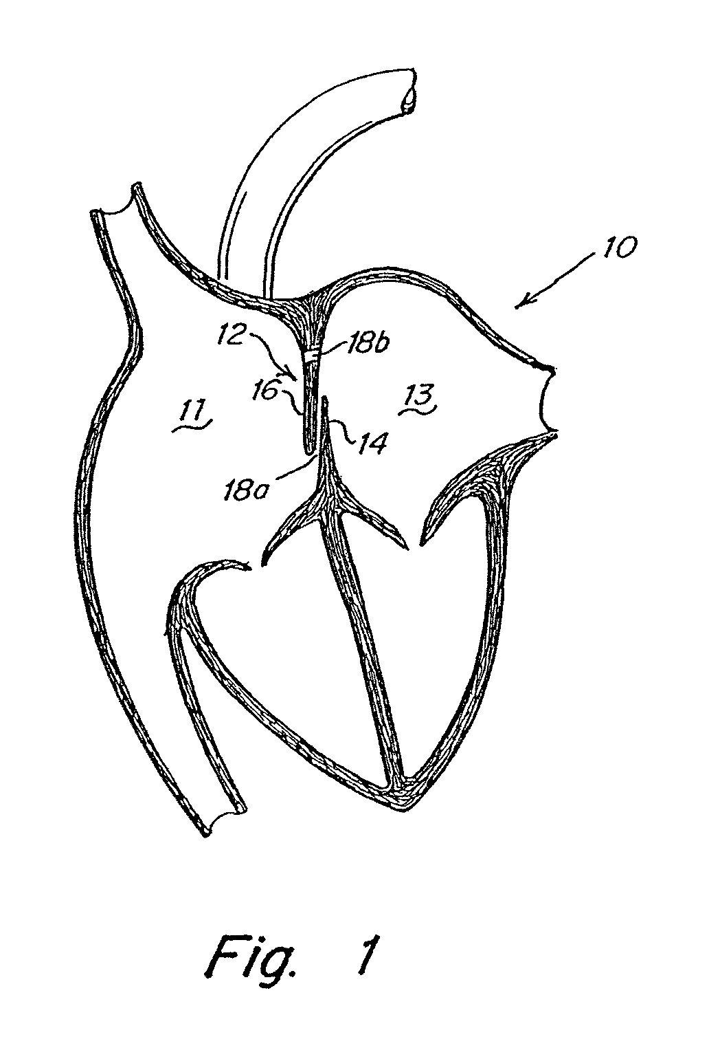 Patent foramen ovale (PFO) closure device with linearly elongating petals