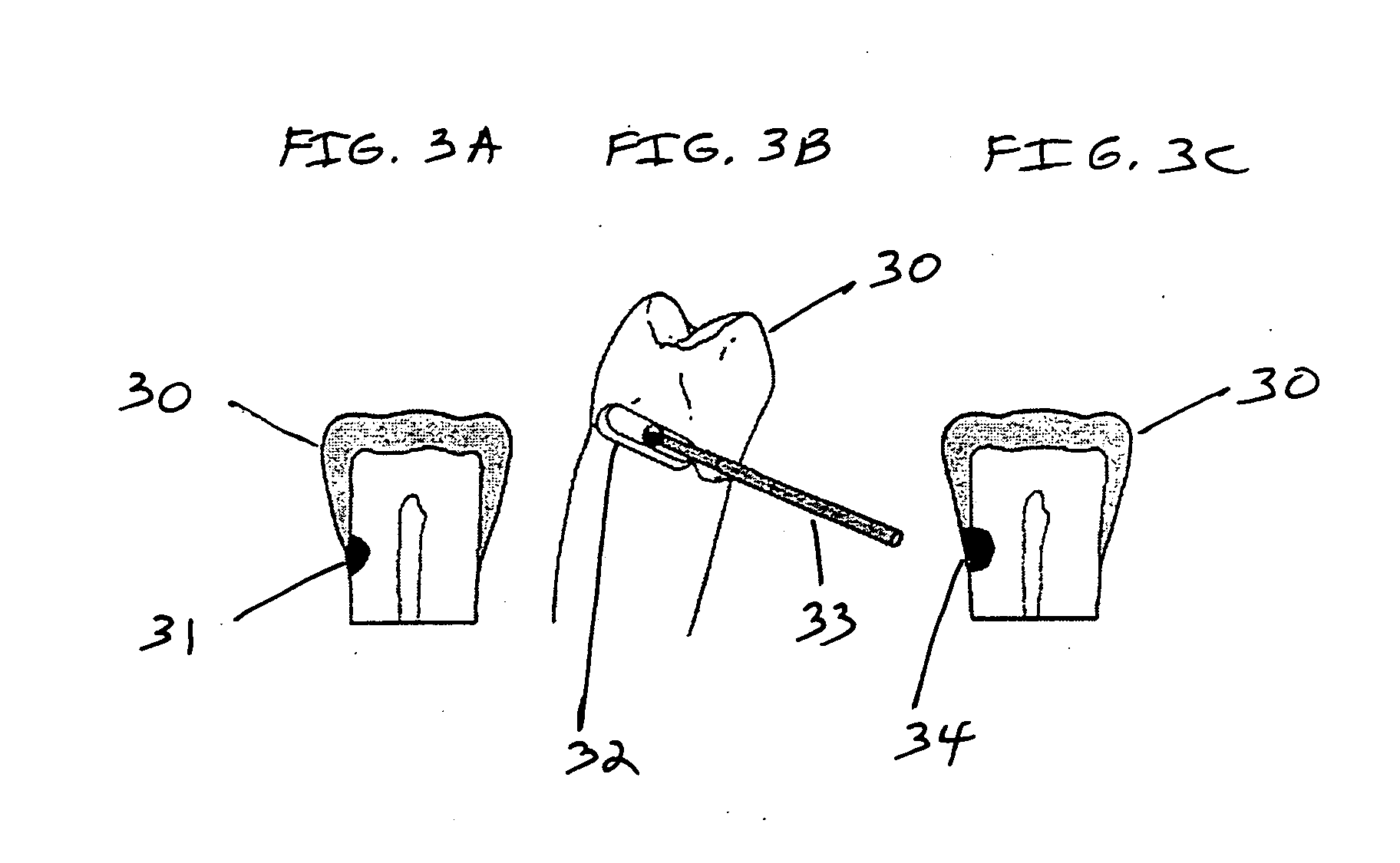 Antimicrobial dental materials, restorations, and prostheses