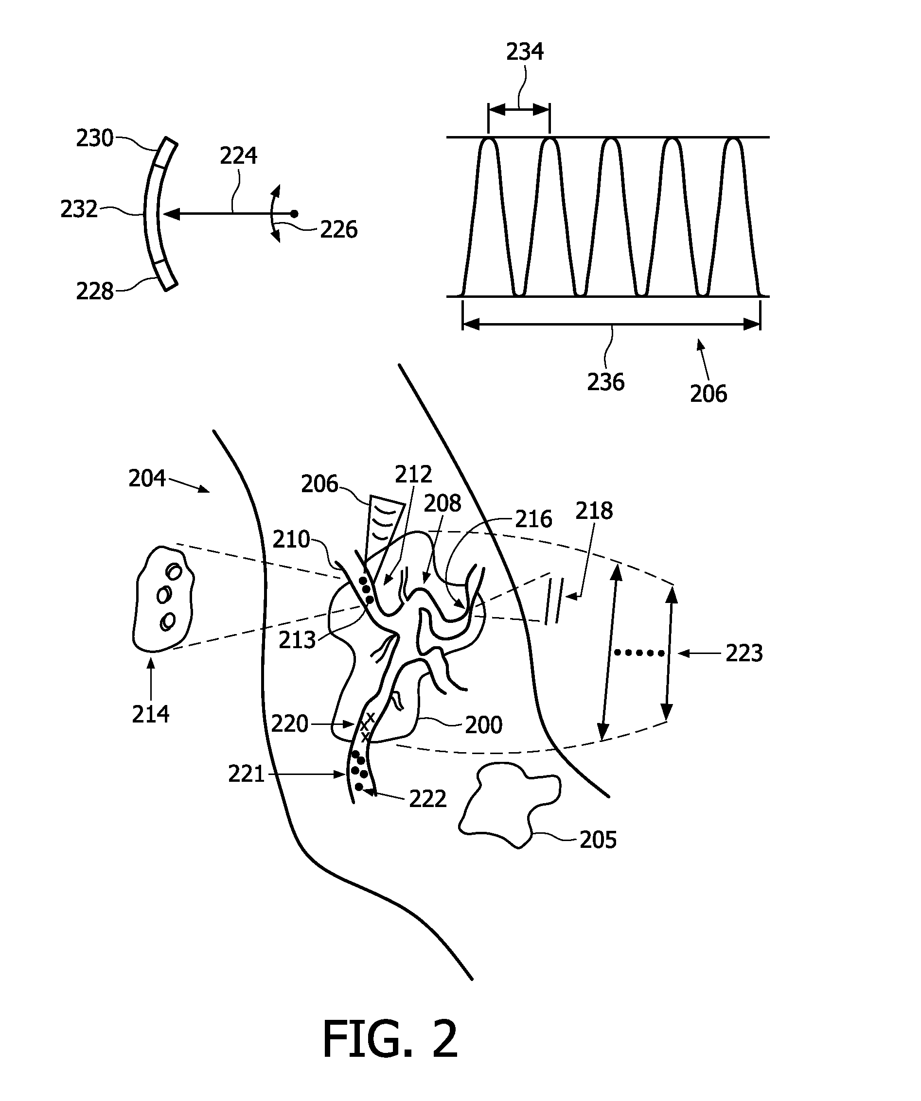 Tumor treatment using ultrasound cavitation