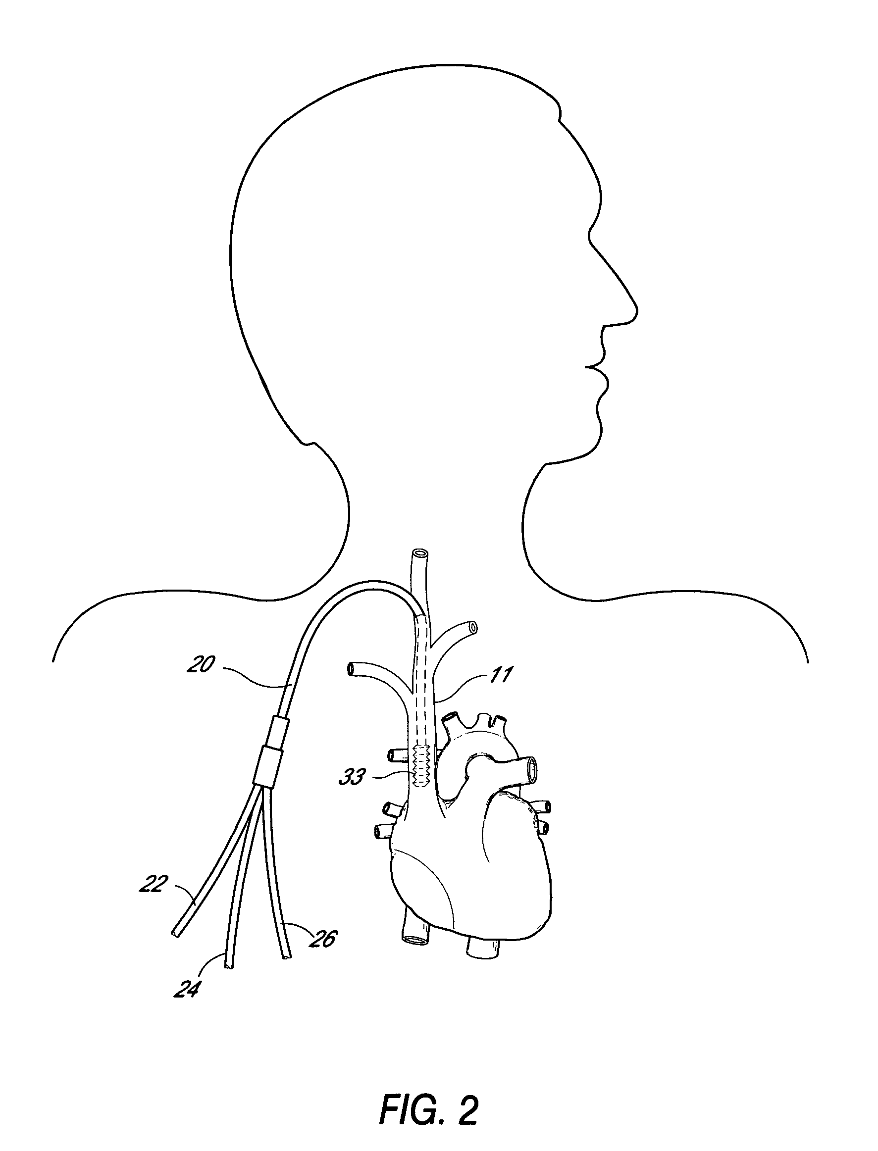 Apparatus and method for in-vivo plasmapheresis using periodic backflush containing anticoagulant