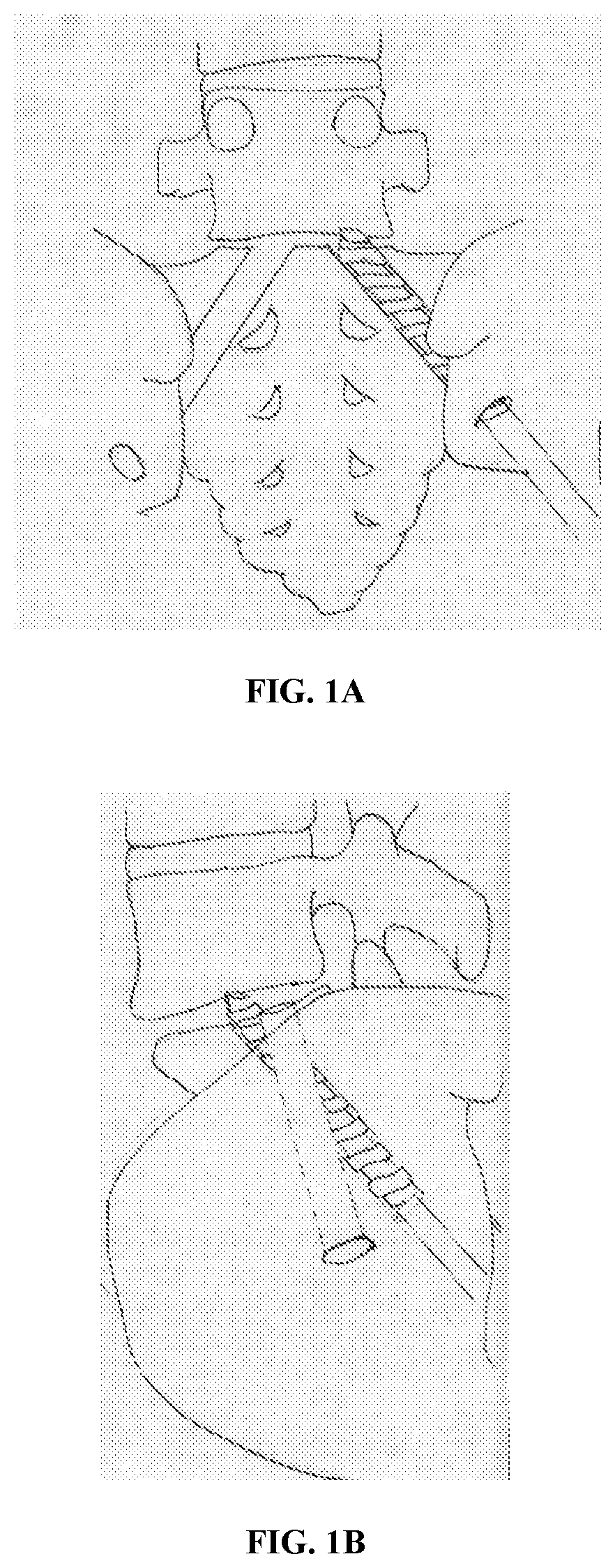 Interlocking implant with expandable fixation means for l5-s1 spinal fusion and/or fixation