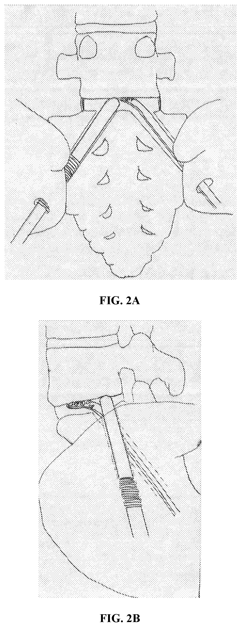 Interlocking implant with expandable fixation means for l5-s1 spinal fusion and/or fixation