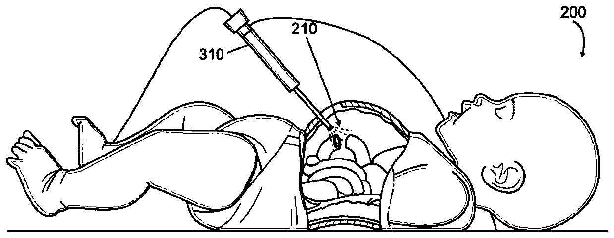 Curled suture device apparatus and method