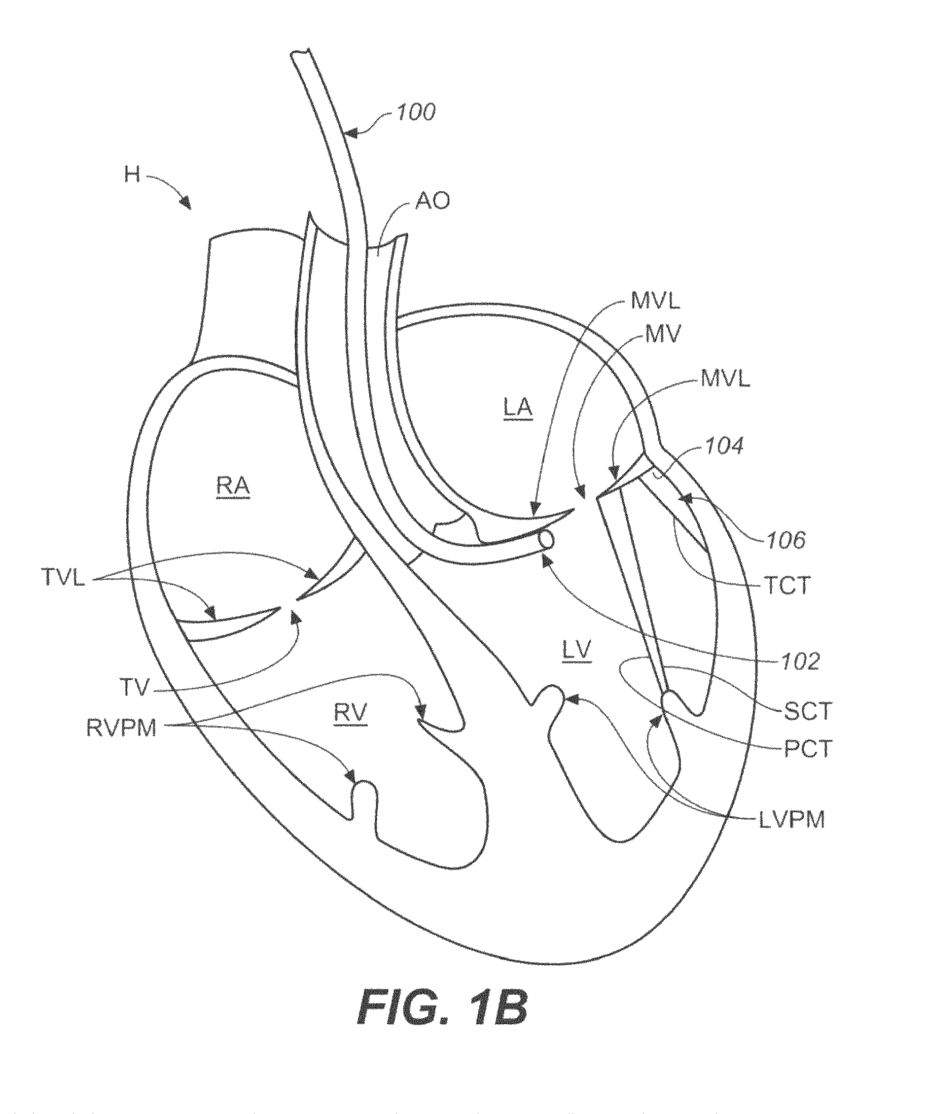 Diagnostic catheters, guide catheters, visualization devices and chord manipulation devices, and related kits and methods