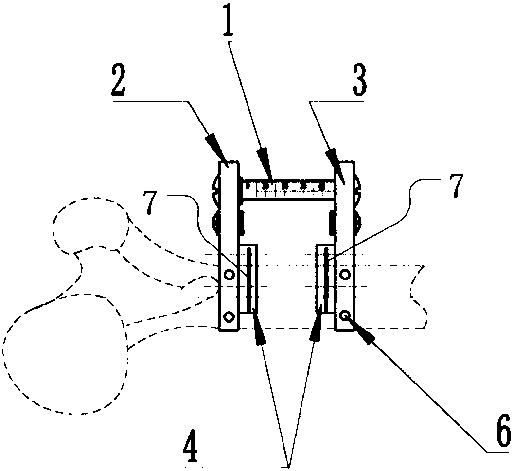 Universal bone cutting guider for congenital acetabulum maldevelopment femur