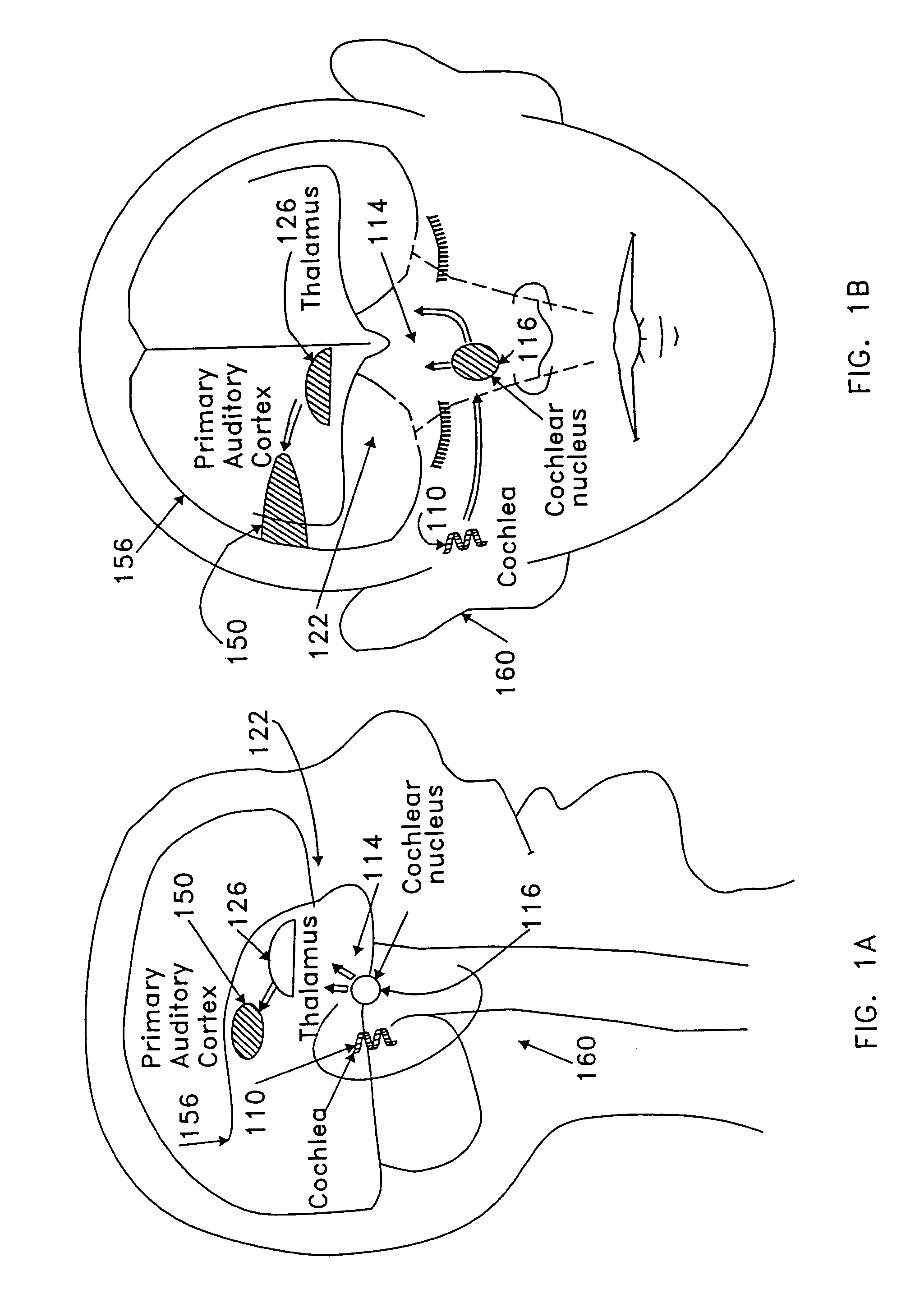 Stereotactic hypothalamic obesity probe