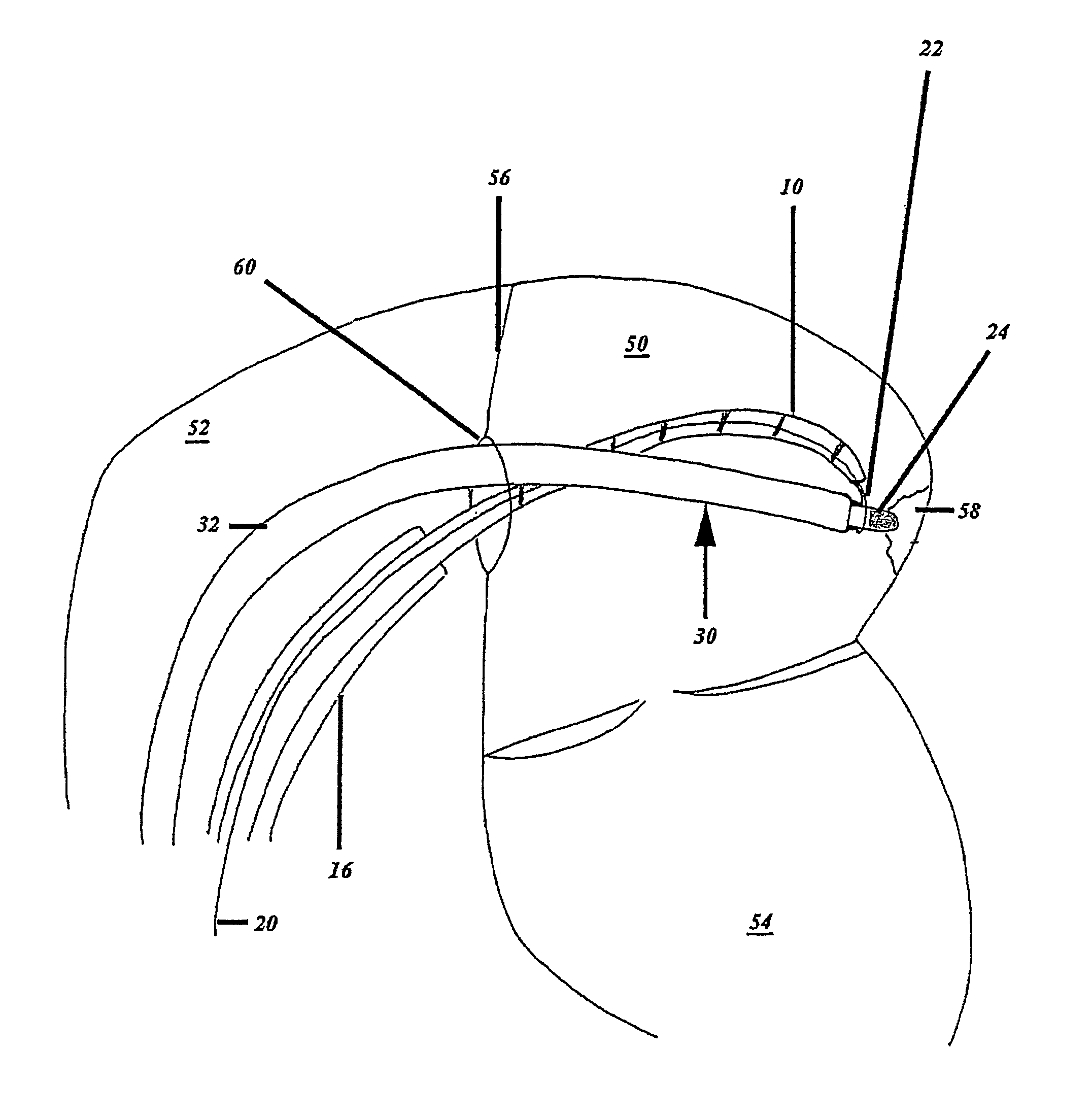 Catheter, apparatus for creating a linear ablation and a method of ablating tissue