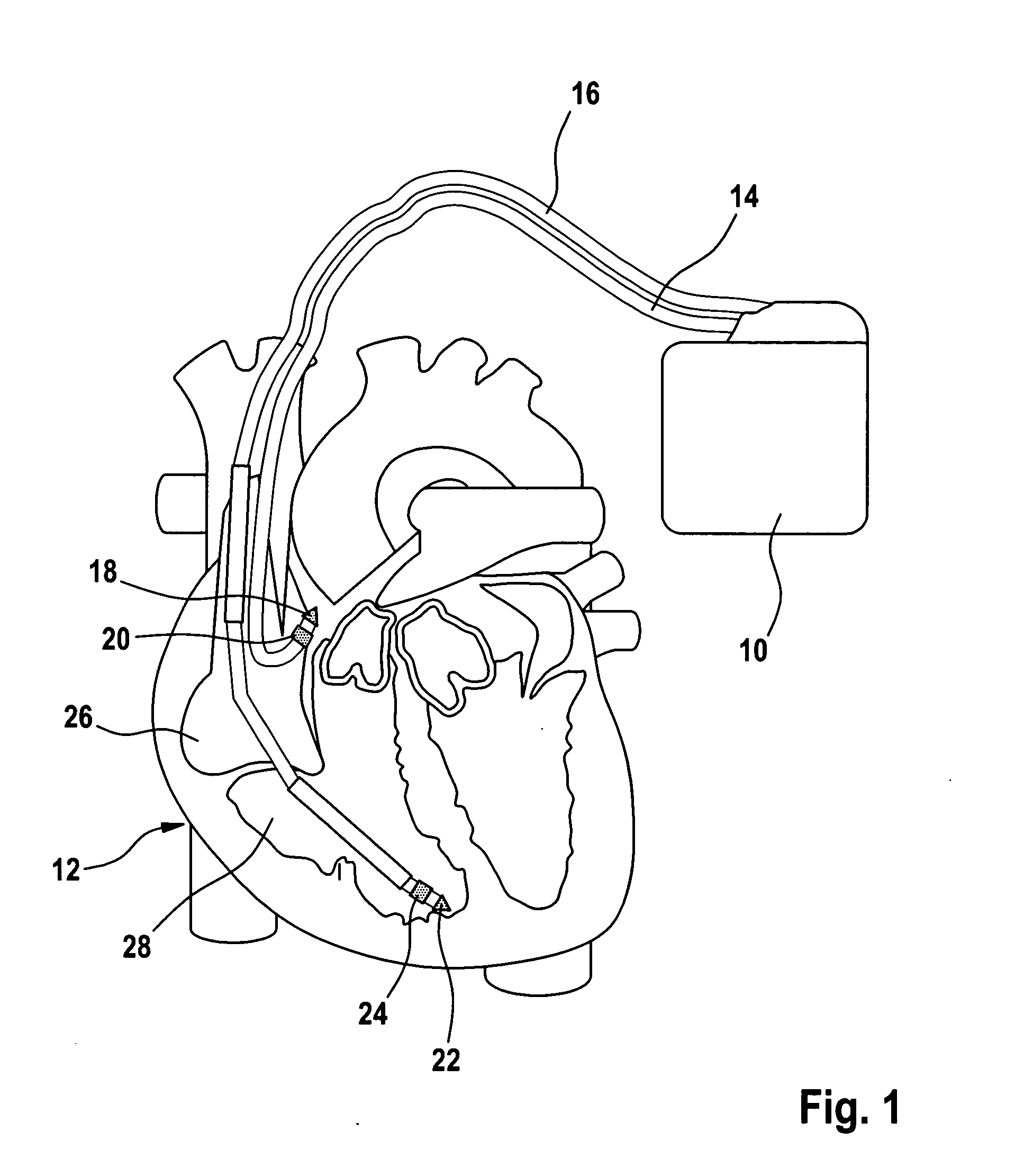 Cardiac pacemaker