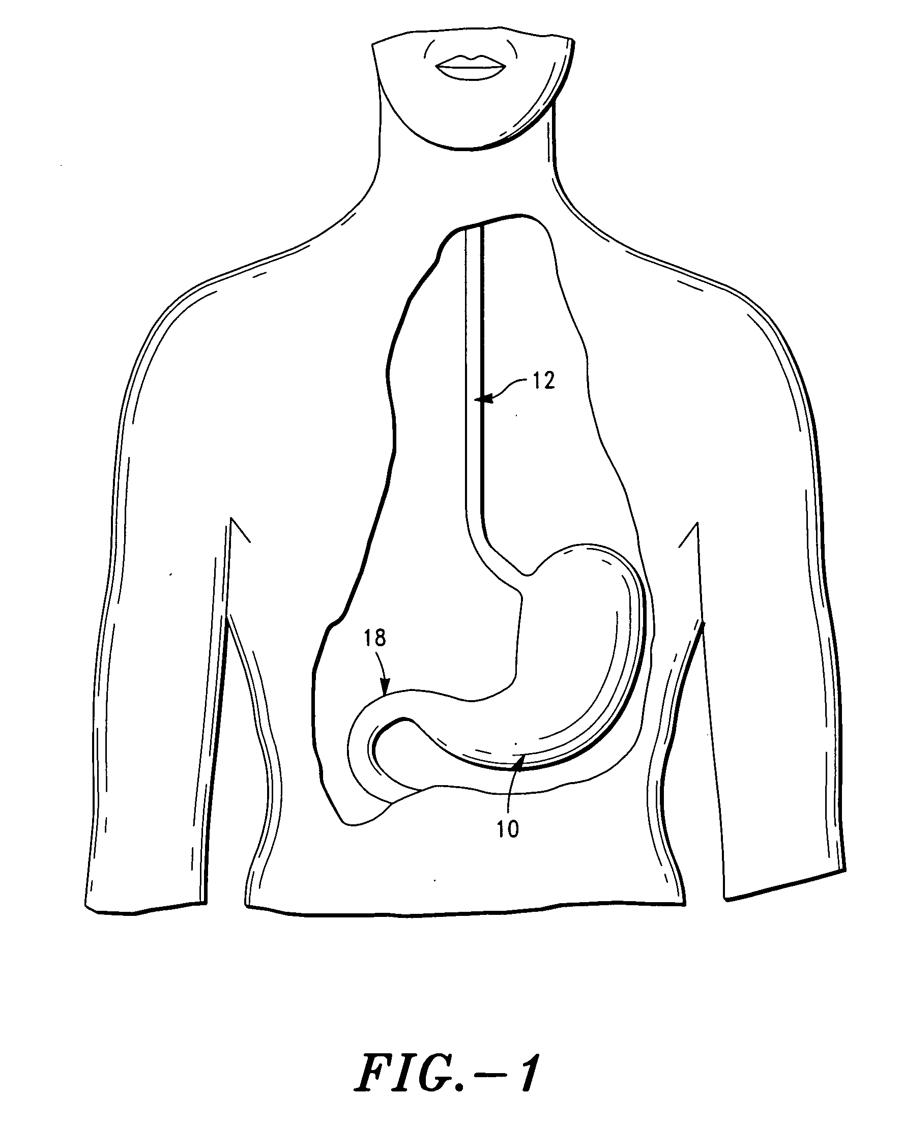 Method and system for treatment of eating disorders