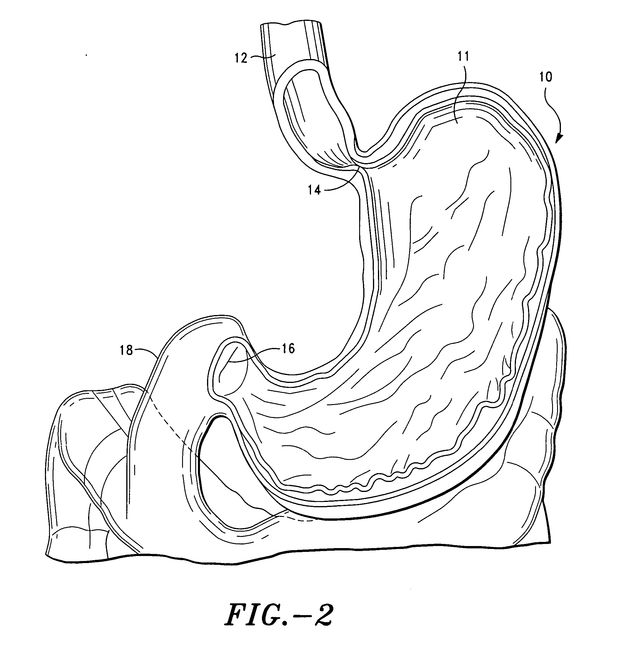 Method and system for treatment of eating disorders